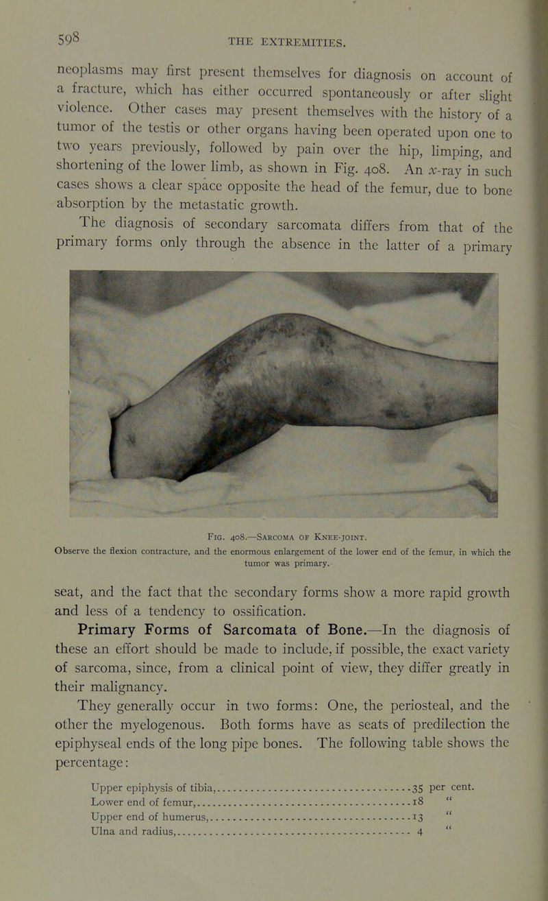 neoplasms may first present themselves for diagnosis on account of a fracture, which has either occurred spontaneously or after shght violence. Other cases may present themselves with the history of a tumor of the testis or other organs having been operated upon one to two years previously, followed by pain over the hip, Hmping, and shortening of the lower hmb, as shown in Fig. 408. An .r-ray in such cases shows a clear space opposite the head of the femur, due to bone absorption by the metastatic growth. The diagnosis of secondary sarcomata differs from that of the primary forms only through the absence in the latter of a primary Fig. 408.—Sarcoma of Knee-joint. Observe the flexion contracture, and the enormous enlargement of the lower end of the femur, in which the tumor was primary. seat, and the fact that the secondary forms show a more rapid growth and less of a tendency to ossification. Primary Forms of Sarcomata of Bone.—In the diagnosis of these an effort should be made to include, if possible, the exact variety of sarcoma, since, from a clinical point of view, they differ greatly in their malignancy. They generally occur in two forms: One, the periosteal, and the other the myelogenous. Both forms have as seats of predilection the epiphyseal ends of the long pipe bones. The following table shows the percentage: Upper epiphysis of tibia, 35 per cent. Lower end of femur, i8  Upper end of humerus, 13  Ulna and radius, 4 