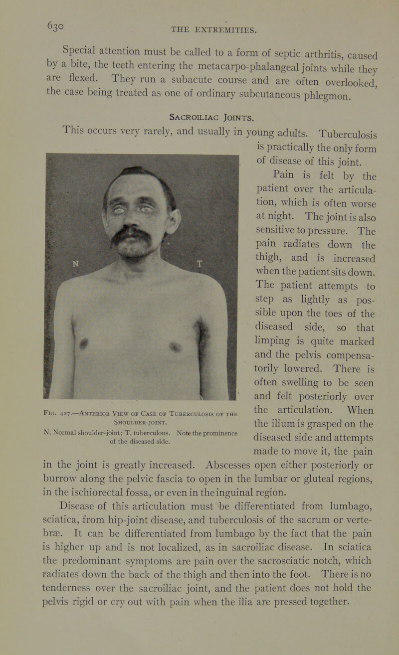 Special attention must be called to a form of septic arthritis, caused by a bite, the teeth entering the metacarpo-phalangeal joints while they are flexed. They run a subacute course and are often overlooked, the case being treated as one of ordinary subcutaneous phlegmon. Sacroiliac Joints. This occurs very rarely, and usually in young adults. Tuberculosis is practically the only form of disease of this joint. Pain is felt by the patient over the articula- tion, which is often worse at night. The joint is also sensitive to pressure. The pain radiates down the thigh, and is increased when the patient sits down. The patient attempts to step as hghtly as pos- sible upon the toes of the diseased side, so that Hmping is quite marked and the pelvis compensa- torily lowered. There is often swelKng to be seen and felt posteriorly over the articulation. When the ilium is grasped on the diseased side and attempts made to move it, the pain in the joint is greatly increased. Abscesses open either posteriorly or burrow along the pelvic fascia to open in the lumbar or gluteal regions, in the ischiorectal fossa, or even in the inguinal region. Disease of this articulation must be differentiated from lumbago, sciatica, from hip-joint disease, and tuberculosis of the sacrum or verte- brae. It can be differentiated from lumbago by the fact that the pain is higher up and is not locaHzed, as in sacroihac disease. In sciatica the predominant symptoms are pain over the sacrosciatic notch, which radiates down the back of the thigh and then into the foot. There is no tenderness over the sacroiliac joint, and the patient does not hold the pelvis rigid or cry out with pain when the iha are pressed together. Fig. 427.—Anterior View of Case of Tuberculosis of the Shoulder-joint. N, Normal shoulder-joint; T, tuberculous. Note the prominence of the diseased side.
