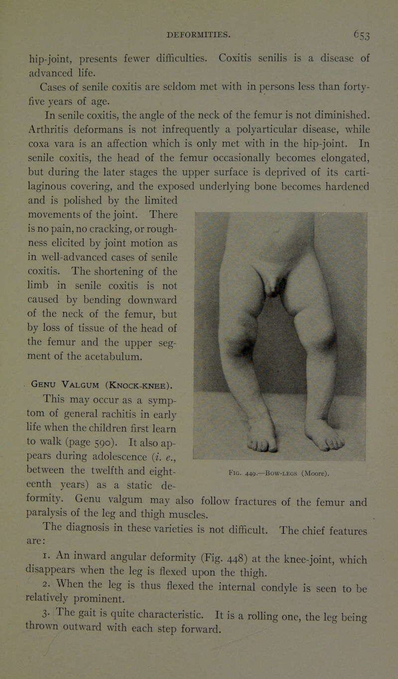 hip-joint, presents fewer difficulties. Coxitis senilis is a disease of advanced life- Cases of senile coxitis are seldom met with in persons less than forty- five years of age. In senile coxitis, the angle of the neck of the femur is not diminished. Arthritis deformans is not infrequently a polyarticular disease, while coxa vara is an affection which is only met with in the hip-joint. In senile coxitis, the head of the femur occasionally becomes elongated, but during the later stages the upper surface is deprived of its carti- laginous covering, and the exposed underlying bone becomes hardened and is pohshed by the limited movements of the joint. There is no pain, no cracking, or rough- ness elicited by joint motion as in well-advanced cases of senile coxitis. The shortening of the Hmb in senile coxitis is not caused by bending downward of the neck of the femur, but by loss of tissue of the head of the femur and the upper seg- ment of the acetabulum. Genu Valgum (Knock-knee). This may occur as a symp- tom of general rachitis in early life when the children first learn to walk (page 590). It also ap- pears during adolescence {i. e., between the twelfth and eight- eenth years) as a static de- formity. Genu valgum may also follow fractures of the femur and paralysis of the leg and thigh muscles. The diagnosis in these varieties is not difficult. The chief features are: 1. An inward angular deformity (Fig. 448) at the knee-joint, which disappears when the leg is flexed upon the thigh. 2. When the leg is thus flexed the internal condyle is seen to be relatively prominent. 3. The gait is quite characteristic. It is a roUing one, the leg being thrown outward with each step forward. Fig. 449.—Bow-legs (Moore).