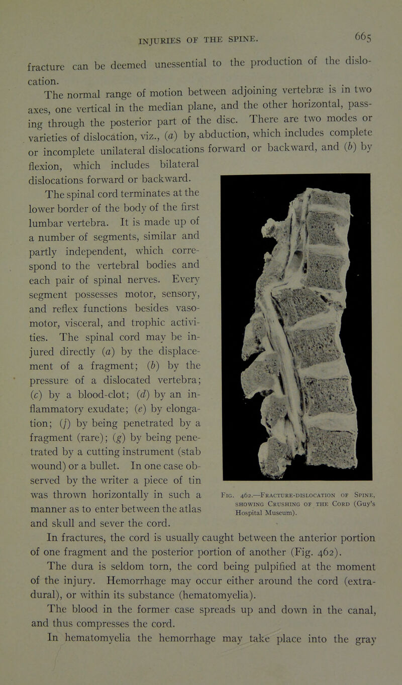 fracture can be deemed unessential to the production of the dislo- cation. . . The normal range of motion between adjoining vertebra is m two axes, one vertical in the median plane, and the other horizontal, pass- ing through the posterior part of the disc. There are two modes or varieties of dislocation, viz., (a) by abduction, which includes complete or incomplete unilateral dislocations forward or backward, and {b) by flexion, which includes bilateral dislocations forward or backward. The spinal cord terminates at the lower border of the body of the first lumbar vertebra. It is made up of a number of segments, similar and partly independent, which corre- spond to the vertebral bodies and each pair of spinal nerves. Every segment possesses motor, sensory, and reflex functions besides vaso- motor, visceral, and trophic activi- ties. The spinal cord may be in- jured directly (a) by the displace- ment of a fragment; (b) by the pressure of a dislocated vertebra; (c) by a blood-clot; (d) by an in- flammatory exudate; (e) by elonga- tion; (/) by being penetrated by a fragment (rare); (g) by being pene- trated by a cutting instrument (stab wound) or a bullet. In one case ob- served by the writer a piece of tin was thrown horizontally in such a manner as to enter between the atlas and skull and sever the cord. In fractures, the cord is usually caught between the anterior portion of one fragment and the posterior portion of another (Fig. 462). The dura is seldom torn, the cord being pulpified at the moment of the injury. Hemorrhage may occur either around the cord (extra- dural), or within its substance (hematomyelia). The blood in the former case spreads up and down in the canal, and thus compresses the cord. In hematomyelia the hemorrhage may take place into the gray Fig. 462.—Fracture-dislocation of Spine, SHOWING Crushing of the Cord (Guy's Hospital Museum).