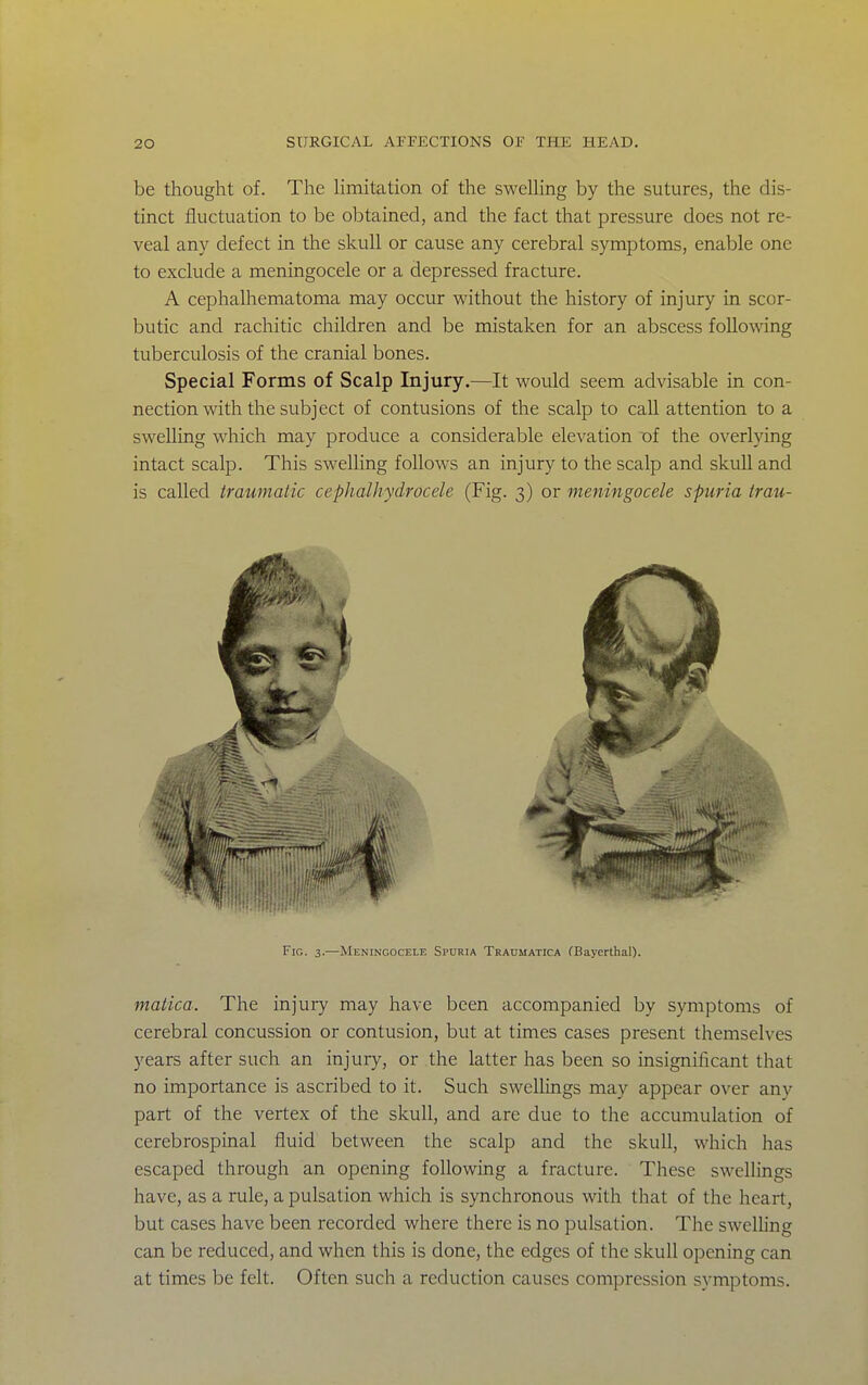 be thought of. The hmitation of the sweUing by the sutures, the dis- tinct fluctuation to be obtained, and the fact that pressure does not re- veal any defect in the skull or cause any cerebral symptoms, enable one to exclude a meningocele or a depressed fracture. A cephalhematoma may occur without the history of injury in scor- butic and rachitic children and be mistaken for an abscess following tuberculosis of the cranial bones. Special Forms of Scalp Injury.—It would seem advisable in con- nection with the subject of contusions of the scalp to call attention to a swelling which may produce a considerable elevation oi the overlying intact scalp. This swelling follows an injury to the scalp and skull and is called traumatic cephalhydrocele (Fig. 3) or meningocele spuria trau- FiG. 3.—Meningocele Spuria Traumatica fBayerthal). matica. The injury may have been accompanied by symptoms of cerebral concussion or contusion, but at times cases present themselves years after such an injury, or the latter has been so insignificant that no importance is ascribed to it. Such swellings may appear over any part of the vertex of the skull, and are due to the accumulation of cerebrospinal fluid between the scalp and the skull, which has escaped through an opening following a fracture. These swellings have, as a rule, a pulsation which is synchronous with that of the heart, but cases have been recorded where there is no pulsation. The swelhng can be reduced, and when this is done, the edges of the skull opening can at times be felt. Often such a reduction causes compression symptoms.