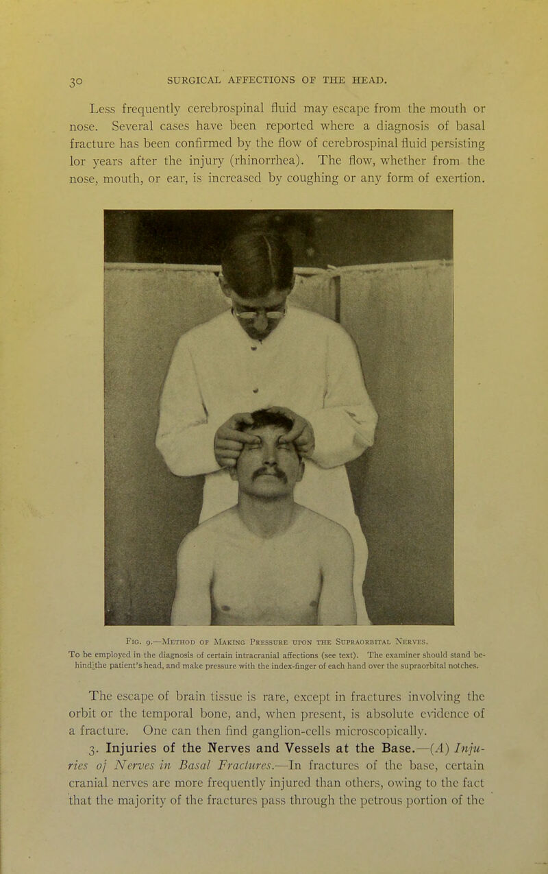 3° Less frequently cerebrospinal fluid may escape from the mouth or nose. Several cases have been reported where a diagnosis of basal fracture has been confirmed by the flow of cerebrospinal fluid persisting lor years after the injury (rhinorrhea). The flow, whether from the nose, mouth, or ear, is increased by coughing or any form of exertion. Fig. 9.—Method or Making Pressure upon the Supraorbital Nerves. To be employed in the diagnosis of certain intracranial affections (see text). The examiner should stand be- hind/the patient's head, and make pressure with the index-finger of each hand over the supraorbital notches. The escape of brain tissue is rare, except in fractures involving the orbit or the temporal bone, and, when present, is absolute evidence of a fracture. One can then find ganglion-cells microscopically. 3. Injuries of the Nerves and Vessels at the Base.—(.4) Iitju- ries oj Nerves in Basal Fractures.—In fractures of the base, certain cranial nerves are more frequently injured than others, owing to the fact that the majority of the fractures pass through the petrous portion of the