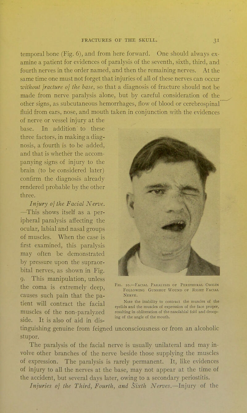temporal bone (Fig. 6), and from here forward. One should always ex- amine a patient for evidences of paralysis of the seventh, sixth, third, and fourth nerves in the order named, and then the remaining nerves. At the same time one must not forget that injuries of all of these nerves can occur ■without fracture of the base, so that a diagnosis of fracture should not be made from nerve paralysis alone, but by careful consideration of the other signs, as subcutaneous hemorrhages, flow of blood or cerebrospinal fluid from ears, nose, and mouth taken in conjunction with the evidences of nerve or vessel injury at the base. In addition' to these three factors, in making a diag- nosis, a fourth is to be added, and that is whether the accom- panying signs of injury to the brain (to be considered later) confirm the diagnosis already rendered probable by the other three. Injury of the Facial Nerve. —^This shows itself as a per- ipheral paralysis affecting the ocular, labial and nasal groups of muscles. WTien the case is first examined, this paralysis may often be demonstrated by pressure upon the supraor- bital nerves, as shown in Fig. 9. This manipulation, unless the coma is extremely deep, causes such pain that the pa- tient will contract the facial muscles of the non-paralyzed side. It is also of aid in dis- tinguishing genuine from feigned unconsciousness or from an alcohohc stupor. The paralysis of the facial nerve is usually unilateral and may in- volve other branches of the nerve beside those supplying the muscles of expression. The paralysis is rarely permanent. It, like evidences of injury to all the nerves at the base, may not appear at the time of the accident, but several days later, owing to a secondary periostitis. Injuries of the Third, Fourth, and ^ixth Nerves.—^Injury of the Fig. 10.—Facial Paralysis of Peripheral Origin Following Gunshot Wound or Right Facial Nerve. Note the inability to contract the muscles of the eyelids and the muscles o£ expression of the face proper, resulting in obliteration of the nasolabial fold and droop- ing of the angle of the mouth.