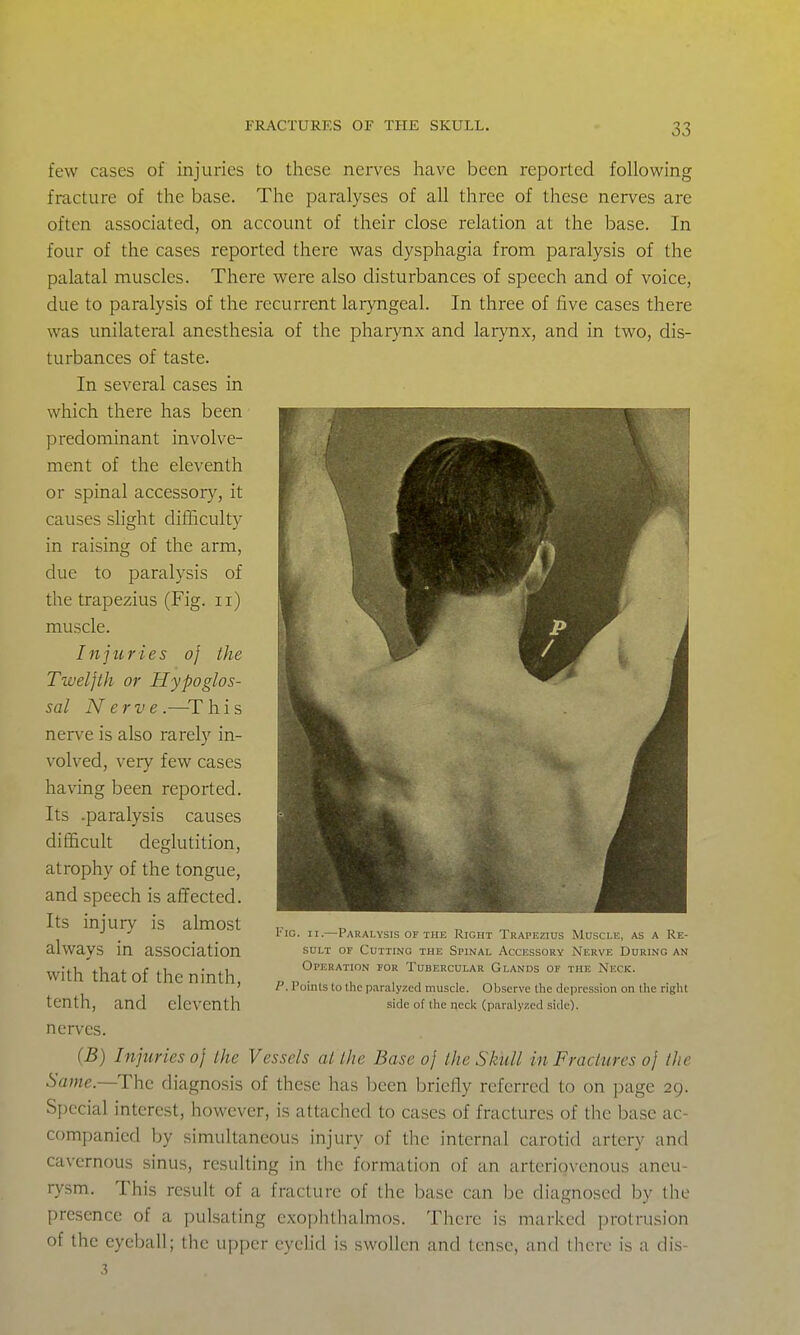 few cases of injuries to these nerves have been reported following fracture of the base. The paralyses of all three of these nerves are often associated, on account of their close relation at the base. In four of the cases reported there was dysphagia from paralysis of the palatal muscles. There were also disturbances of speech and of voice, due to paralysis of the recurrent laryngeal. In three of five cases there was unilateral anesthesia of the pharynx and larynx, and in two, dis- turbances of taste. In several cases in which there has been predominant involve- ment of the eleventh or spinal accessory, it causes slight difficulty in raising of the arm, due to paralysis of the trapezius (Fig. ii) muscle. Injuries oj the Twelfth or Hypoglos- sal Nerve.—^T h i s nerve is also rarely in- volved, very few cases having been reported. Its .paralysis causes difficult deglutition, atrophy of the tongue, and speech is affected. Its injury is almost always in association with that of the ninth, tenth, and eleventh nerves. {B) Injuries oj the Vessels al the Base oj the Skiill in Fractures oj the Same.—The diagnosis of these has l)een briefly referred to on page 29. Special interest, however, is attached to cases of fractures of the base ac- companied by simultaneous injury of the internal carotid artery and cavernous sinus, resulting in the formation of an arteriovenous aneu- rysm. This result of a fracture of the base can be diagnosed by the presence of a pulsating exophthalmos. There is marked protrusion of the eyeball; the upper eyelid is swollen and tense, and thtMv is a dis- 3 Fig. II.—Paralysis OF THE Right Trapezius Muscle, as a Re- sult OF Cutting the Spinal Accessory Nerve During an Opf.ration for Tubercular Glands of the Neck. P. Poinls to the paralyzed muscle. Observe the dejiression on the right side of the necli (paralyzed side).