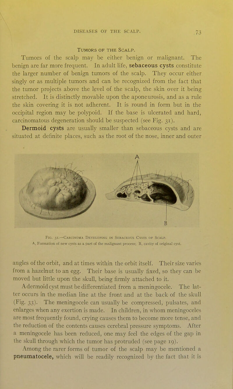 Tumors of the Scalp. Tumors of the scalp may be either benign or malignant. The benign are far more frequent. In adult life, sebaceous cysts constitute the larger number of benign tumors of the scalp. They occur either singly or as multiple tumors and can be recognized from the fact that the tumor projects above the level of the scalp, the skin over it being stretched. It is distinctly movable upon the aponeurosis, and as a rule the skin covering it is not adherent. It is round in form but in the occipital region may be polypoid. If the base is ulcerated and hard, carcinomatous degeneration should be suspected (see Fig. 31). Dermoid cysts are usually smaller than sebaceous cysts and are situated at definite places, such as the root of the nose, inner and outer A B Fig. 31.—Carcinoma Developing in Sebaceous Cysts of Scalp. A, Formation of new cj'sts as a part of the malignant process; B, cavity of original cyst. angles of the orbit, and at times within the orbit itself. Their size varies from a hazelnut to an egg. Their base is usually fixed, so they can be moved but httle upon the skull, being firmly attached to it. A dermoid cyst must be differentiated from a meningocele. The lat- ter occurs in the median line at the front and at the back of the skull (Fig- 33)- The meningocele can usually be compressed, pulsates, and enlarges when any exertion is made. In children, in whom meningoceles are most freciuently found, crying causes them to become more tense, and the reduction of the contents causes cerebral pressure symptoms. After a meningocele has been reduced, one may feel the edges of the gap in the skull through which the tumor has protruded (.see page 19). Among the rarer forms of tumor of the scalp may be mentioned a pneumatocele, which will be readily recognized by the fact that it is