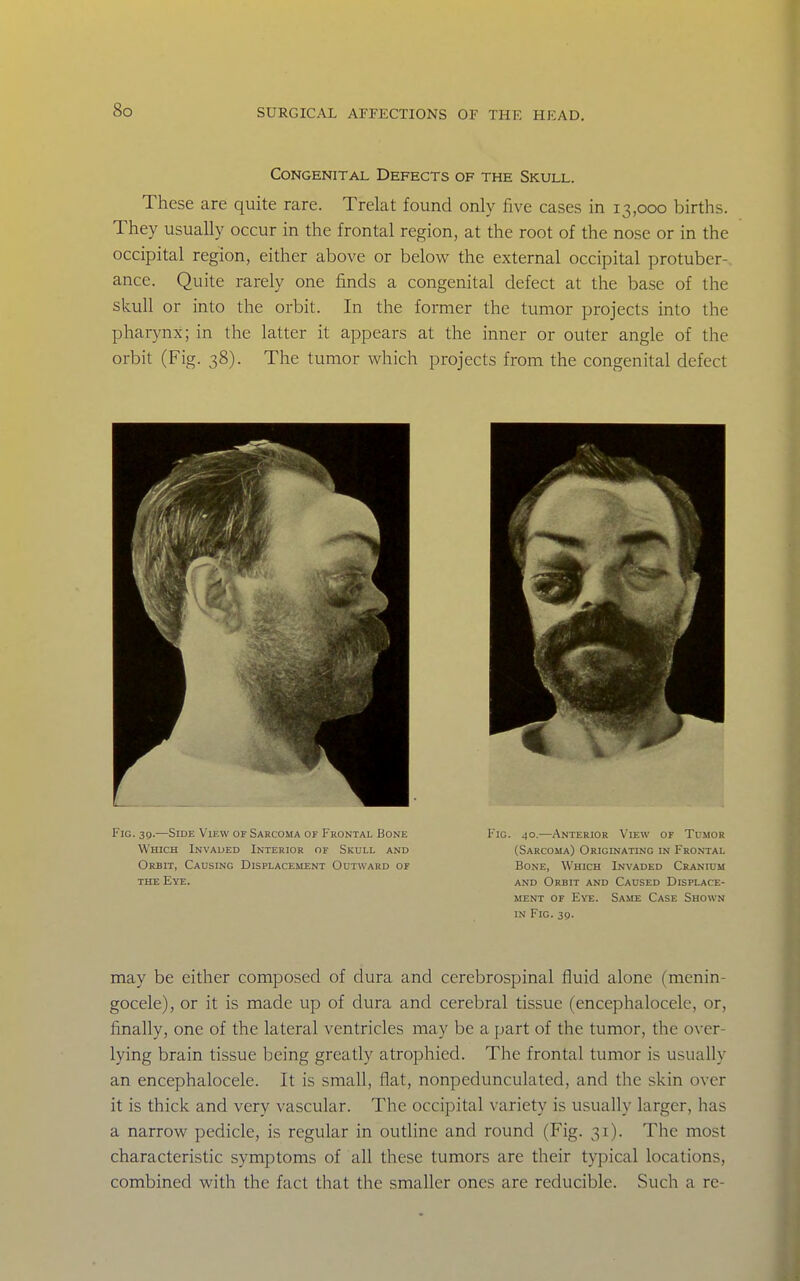 Congenital Defects of the Skull. These are quite rare. Trelat found only live cases in 13,000 births. They usually occur in the frontal region, at the root of the nose or in the occipital region, either above or below the external occipital protuber-. ance. Quite rarely one finds a congenital defect at the base of the skull or into the orbit. In the former the tumor projects into the pharynx; in the latter it appears at the inner or outer angle of the orbit (Fig. 38). The tumor which projects from the congenital defect Fig. 39.—Side View of Sarcoma of Frontal Bone Which Invaded Interior or Skull and Orbit, Causing Displacement Outward of THE Eye. Fig. ^o.—Anterior View of Tumor (Sarcoma) ORiorNATiNG in Frontal Bone, Which Invaded Cranium AND Orbit and Caused Displace- ment of Eye. Same Case Shown IN Fig. 3q. may be either composed of dura and cerebrospinal fluid alone (menin- gocele), or it is made up of dura and cerebral tissue (encephalocelc, or, finally, one of the lateral ventricles may be a part of the tumor, the over- lying brain tissue being greatly atrophied. The frontal tumor is usually an encephalocelc. It is small, flat, nonpedunculated, and the skin over it is thick and very vascular. The occipital variety is usually larger, has a narrow pedicle, is regular in outline and round (Fig. 31). The most characteristic symptoms of all these tumors are their typical locations, combined with the fact that the smaller ones are reducible. Such a re-