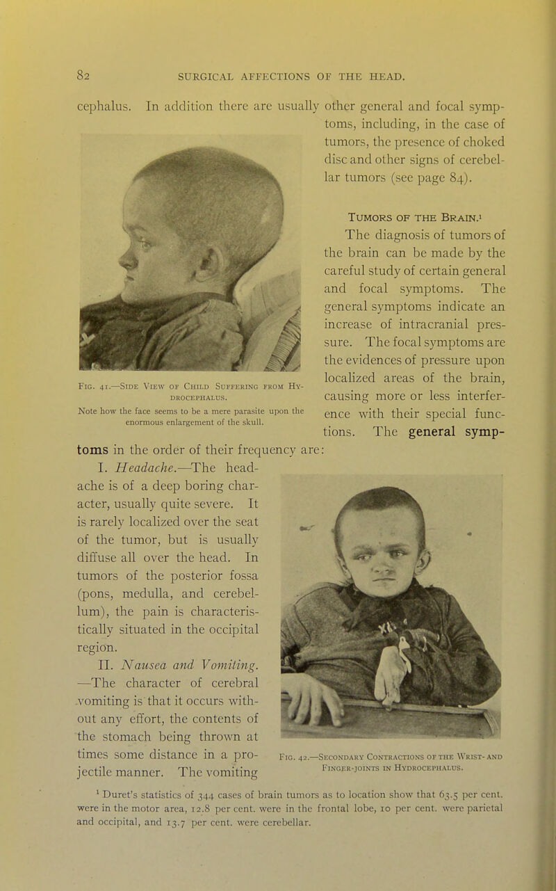 cephalus. In addition there are usually other general and focal symp- toms, including, in the case of tumors, the presence of choked disc and other signs of cerebel- lar tumors (see page 84). Tumors of the Brain.» The diagnosis of tumors of the brain can be made by the careful study of certain general and focal symptoms. The general symptoms indicate an increase of intracranial pres- sure. The focal symptoms are the evidences of pressure upon locaHzed areas of the brain, causing more or less interfer- ence with their special func- tions. The general symp- e: Fig. 41.—Side View of Child Suffering from Hy- drocephalus. Note how the face seems to be a mere parasite upon the enonnous enlargement of the skull. toms in the order of their frequency ar I. Headache.—^The head- ache is of a deep boring char- acter, usually quite severe. It is rarely localized over the seat ^, of the tumor, but is usually diffuse all over the head. In tumors of the posterior fossa (pons, medulla, and cerebel- lum), the pain is characteris- tically situated in the occipital region. II. Nausea and Vomiting. —The character of cerebral .vomiting is that it occurs with- out any effort, the contents of the stomach being thrown at times some distance in a pro- jectile manner. The vomiting Fig. 42.—Secondary Contractions of the Wrist- and Finger-joints in Hydrocephalus. ' Buret's statistics of 344 cases of brain tumors as to location show that 63.5 per cent, were in the motor area, 12.8 per cent, were in the frontal lobe, 10 per cent, were parietal and occipital, and 13.7 per cent, were cerebellar.