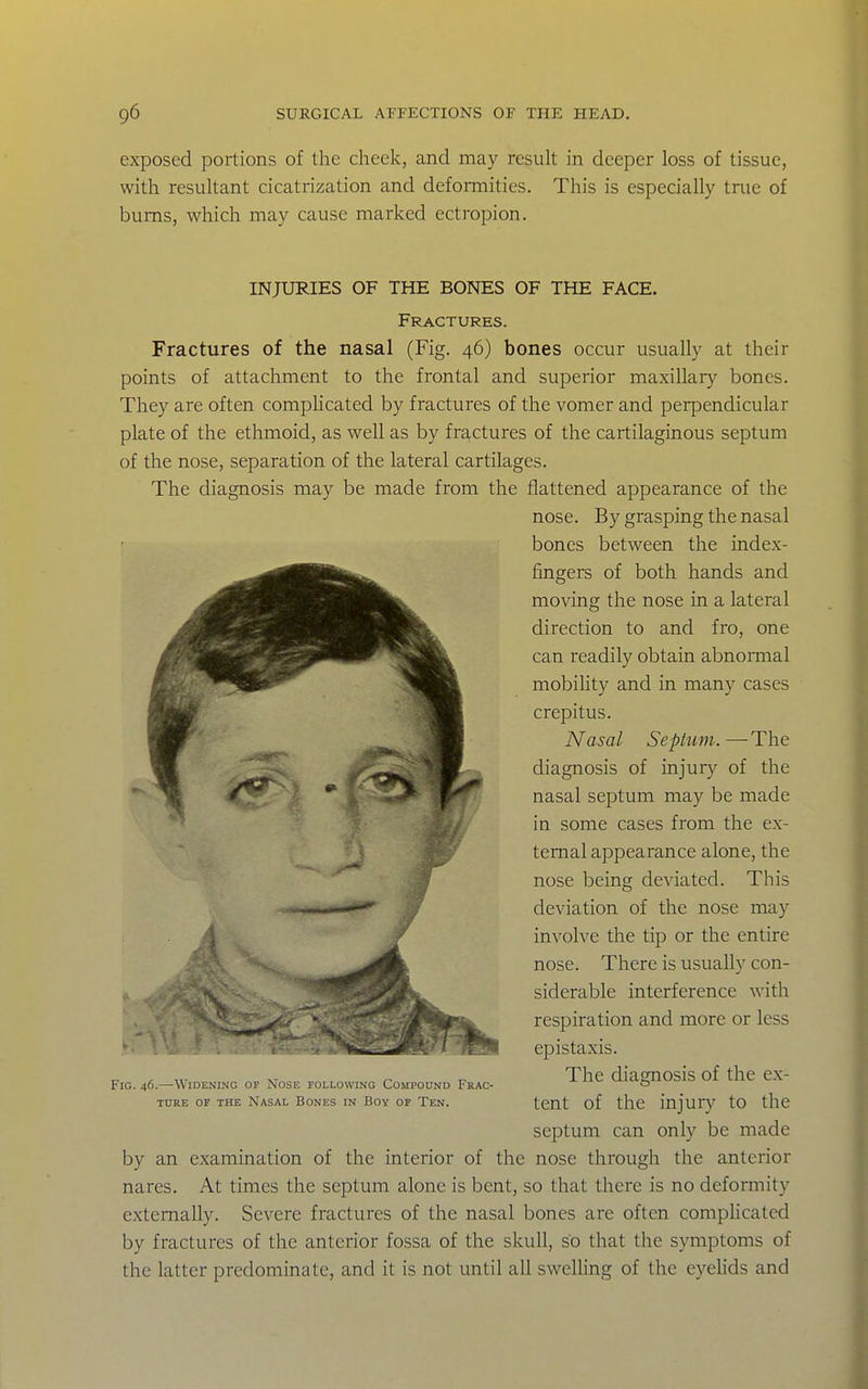 exposed portions of the cheek, and may result in deeper loss of tissue, with resultant cicatrization and deformities. This is especially true of bums, which may cause marked ectropion. INJURIES OF THE BONES OF THE FACE. Fractures. Fractures of the nasal (Fig. 46) bones occur usually at their points of attachment to the frontal and superior maxillary bones. They are often compUcated by fractures of the vomer and perpendicular plate of the ethmoid, as well as by fractures of the cartilaginous septum of the nose, separation of the lateral cartilages. The diagnosis may be made from the flattened appearance of the nose. By grasping the nasal bones between the index- fingers of both hands and moving the nose in a lateral direction to and fro, one can readily obtain abnormal mobihty and in many cases crepitus. Nasal Septum. —The diagnosis of injury of the nasal septum may be made in some cases from the ex- ternal appearance alone, the nose being deviated. This deviation of the nose may invoh'e the tip or the entire nose. There is usually con- siderable interference with respiration and more or less epistaxis. The diagnosis of the ex- tent of the injur}^ to the septum can only be made by an examination of the interior of the nose through the anterior nares. At times the septum alone is bent, so that there is no deformity externally. Severe fractures of the nasal bones are often complicated by fractures of the anterior fossa of the skull, so that the symptoms of the latter predominate, and it is not until all swelling of the eyehds and Fig. 46.—Widening of Nose following Compound L kac- TURE OF THE NASAL BoNES IN BOY OF TeN.