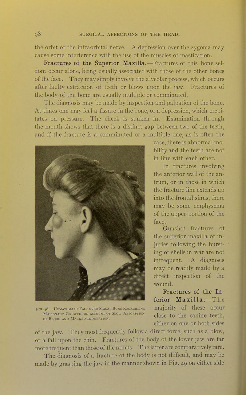 the orbit or the infraorbital nerve. A depression over the zygoma may cause some interference with the use of the muscles of mastication. Fractures of the Superior Maxilla.—Fractures of this bone sel- dom occur alone, being usually associated with those of the other bones of the face. They may simply involve the alveolar process, which occurs after faulty extraction of teeth or blows upon the jaw. Fractures of the body of the bone are usually multiple or comminuted. The diagnosis may be made by inspection and palpation of the bone. At times one may feel a fissure in the bone, or a depression, which crepi- tates on pressure. The cheek is sunken in. Examination through the mouth shows that there is a distinct gap between two of the teeth, and if the fracture is a comminuted or a multiple one, as is often the case, there is abnormal mo- biHty and the teeth are not in hne with each other. In fractures invohdng the anterior wall of the an- tmm, or in those in which the fracture line extends up into the frontal sinus, there may be some emphysema of the upper portion of the face. Gunshot fractures of the superior maxilla or in- juries following the burst- ing of shells in war are not infrequent. A diagnosis may be readily made by a direct inspection of the wound. Fractures of the In- ferior Maxilla.—The majority of these occur close to the canine teeth, either on one or both sides of the jaw. They most frequently follow a direct force, such as a blow, or a fall upon the chin. Fractures of the body of the lower jaw are far more frequent than those of the ramus. The latter are comparatively rare. The diagnosis of a fracture of the body is not difficult, and may be made by grasping the jaw in the manner shown in Fig. 49 on either side