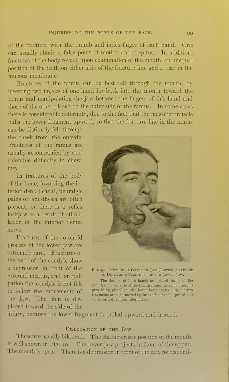 of the fracture, with the thumb and index-finger of each hand. One can usually obtain a false point of motion and crepitus. In addition, fractures of the body reveal, upon examination of the mouth, an unequal position of the teeth on either side of the fracture line and a tear in the mucous membrane. Fractures of the ramus can be best felt through the mouth, by inserting two fingers of one hand far back into the mouth toward the ramus and manipulating the jaw between the fingers of this hand and those of the other placed on the outer side of the ramus. In some cases there is considerable defomiity, due to the fact that the masseter muscle pulls the lower fragment upward, so that the fracture fine in the ramus can be distinctly felt through the cheek from the outside. Fractures of the ramus are usually accompanied by con- siderable difficulty in chew- ing. In fractures of the body of the bone, involving the in- ferior dental canal, neuralgic pains or anesthesia are often present, or there is a reflex lockjaw as a result of stimu- lation of the inferior dental nerve. Fractures of the coronoid process of the lower jaw are extremely rare. Fractures of the neck of the condyle show a depression in front of the external meatus, and on pal- pation the condyle is not felt to follow the movements of the jaw. The chin is dis- placed toward the side of the injury, because the lower fragment is pulled upward and inward. Dislocation of the Jaw. These are usually bilateral. The characteristic position of the mouth is well shown in Fig. 49. The lower jaw projects in front of the upper. The mouth is open. There is a depression in front of the ear, corrcspond- FiG. 4g.—Method of Grasping Jaw (Lower), in Order TO Determine Fractures of the Lower Jaw. The tliumbs of both hands are placed inside of the mouth on eitlicr side of the fracture line, the remaining fin- Kcrs being placed on the lower border externally, the two fragments are then moved against each other in upward and downward directions alternately.