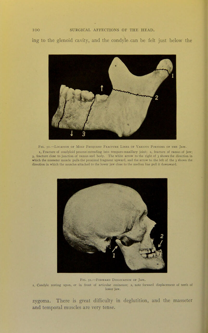 ing to the glenoid cavity, and the condyle can be felt just below the Fig. so.—Location of Most Frequent Fracture Lines op Various Portions of the Jaw. I, Fracture of condyloid process extending into temporo-maxillary joint; 2, fracture of ramus of jaw; 3, fracture dose to junction of ramus and body. The white arrow to the right of 3 shows the direction in which the masseter muscle pulls the proximal fragment upward, and the arrow to the left of the 3 shows the direction in which the muscles attached to the lower jaw close to the median line pull it downward. Fig. 51.—Forward Dislocation of Jaw. I, Condyle resting upon, or in front of articular eminence; 2, note forward displacement of teeth of lower jaw. zygoma. There is great difhculty in deglutition, and the masseter and temporal muscles are very tense.