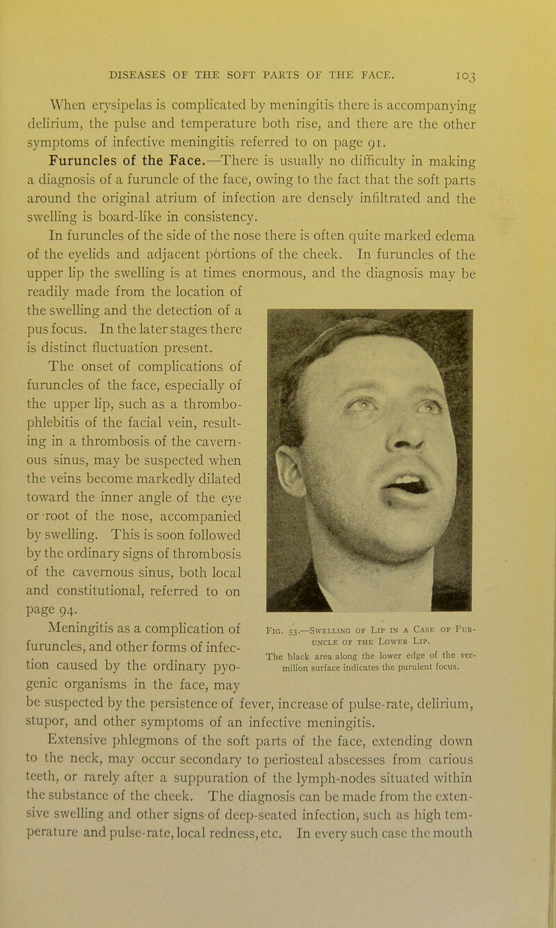 When erysipelas is complicated by meningitis there is accompanying deHrium, the pulse and temperature both rise, and there are the other symptoms of infective meningitis referred to on page 91. Furuncles of the Face.—^There is usually no difficulty in making a diagnosis of a furuncle of the face, owing to the fact that the soft parts around the original atrium of infection are densely infiltrated and the sweUing is board-hke in consistency. In furuncles of the side of the nose there is often quite marked edema of the eyelids and adjacent portions of the cheek. In furuncles of the upper Up the swelUng is at times enormous, and the diagnosis may be readily made from the location of the swelling and the detection of a pus focus. In the later stages there is distinct fluctuation present. The onset of comphcations of furuncles of the face, especially of the upper lip, such as a thrombo- phlebitis of the facial vein, result- ing in a thrombosis of the cavern- ous sinus, may be suspected when the veins become markedly dilated toward the inner angle of the eye or root of the nose, accompanied by sweUing. This is soon followed by the ordinary signs of thrombosis of the cavernous sinus, both local and constitutional, referred to on page 94. Meningitis as a compHcation of furuncles, and other forms of infec- tion caused by the ordinary pyo- genic organisms in the face, may be suspected by the persistence of fever, increase of pulse-rate, delirium, stupor, and other symptoms of an infective meningitis. Extensive phlegmons of the soft parts of the face, extending down to the neck, may occur secondary to periosteal abscesses from carious teeth, or rarely after a suppuration of the lymph-nodes situated within the substance of the cheek. The diagnosis can be made from the exten- sive swelling and other signs of deep-seated infection, such as high tem- perature and pulse-ratc, local redness, etc. In every such case the mouth Fig. 53.—Swelling of Lip in a Case of Fur- uncle OF THE Lower Lip. The bUack area along the lower edge of the vcr- miUon surface indicates the purulent focus.