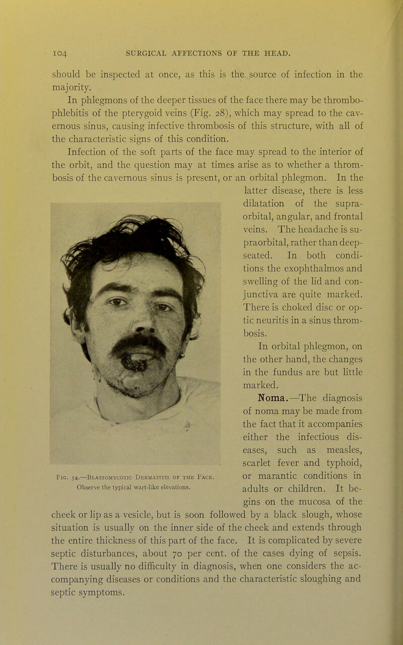 should be inspected at once, as this is the source of infection in the majority. In phlegmons of the deeper tissues of the face there may be thrombo- phlebitis of the pterygoid veins (Fig. 28), which may spread to the cav- ernous sinus, causing infective thrombosis of this structure, with all of the characteristic signs of this condition. Infection of the soft parts of the face may spread to the interior of the orbit, and the question may at times arise as to whether a throm- bosis of the cavernous sinus is present, or an orbital phlegmon. In the latter disease, there is less dilatation of the supra- orbital, angular, and frontal veins. The headache is su- praorbital, rather than deep- seated. In both condi- tions the exophthalmos and swelhng of the Ud and con- junctiva are quite marked. There is choked disc or op- tic neuritis in a sinus throm- bosis. In orbital phlegmon, on the other hand, the changes in the fundus are but httle marked. Noma.—^The diagnosis of noma may be made from the fact that it accompanies either the infectious dis- eases, such as measles, scarlet fever and typhoid. Fig. 54.—Blastomycotic Dermatitis of the Face. Or marantic conditions in Observe the typical wart-like elevations. adultS Or children. It bc- gins on the mucosa of the cheek or lip as a vesicle, but is soon followed by a black slough, whose situation is usually on the inner side of the cheek and extends through the entire thickness of this part of the face. It is compUcated by severe septic disturbances, about 70 per cent, of the cases dying of sepsis. There is usually no difficulty in diagnosis, when one considers the ac- companying diseases or conditions and the characteristic sloughing and septic symptoms.