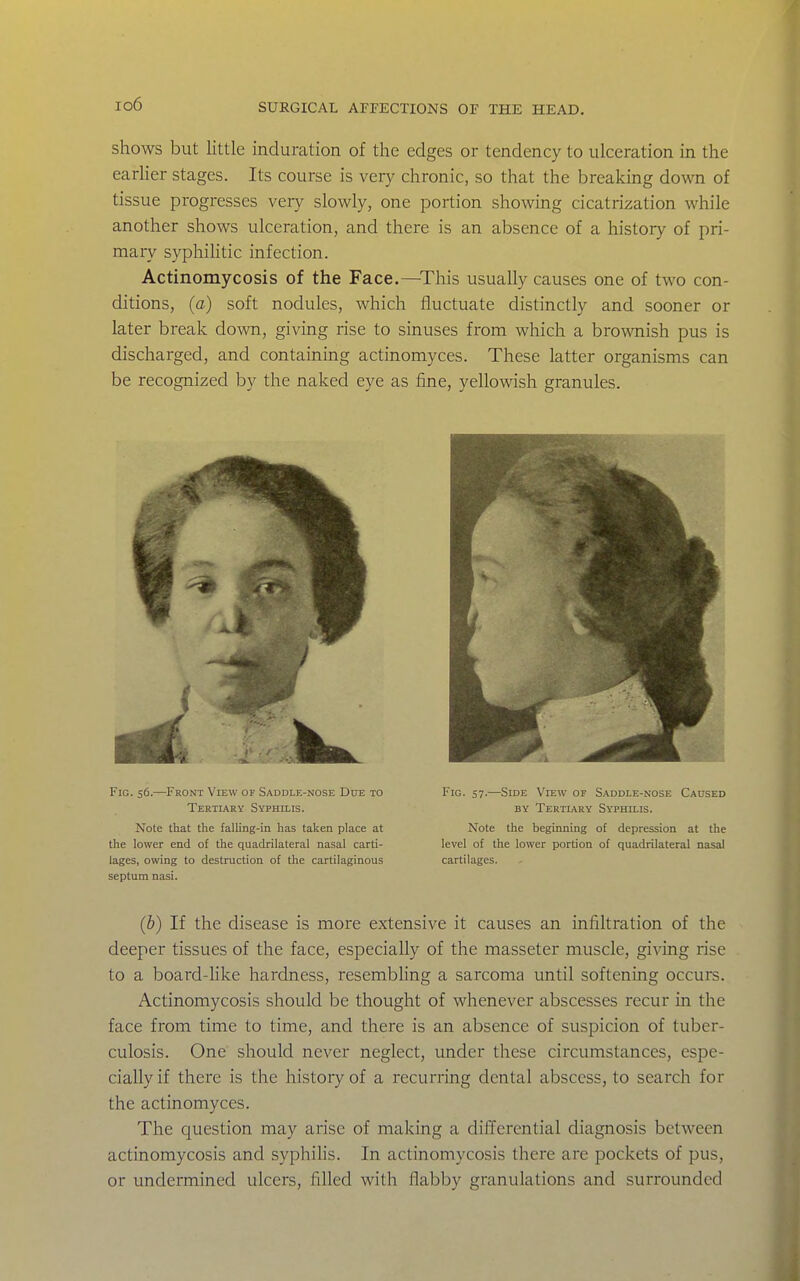 io6 shows but little induration of the edges or tendency to ulceration in the earlier stages. Its course is very chronic, so that the breaking down of tissue progresses very slowly, one portion showing cicatrization while another shows ulceration, and there is an absence of a history of pri- mary syphihtic infection. Actinomycosis of the Face.—^This usually causes one of two con- ditions, (a) soft nodules, which fluctuate distinctly and sooner or later break down, giving rise to sinuses from which a brownish pus is discharged, and containing actinomyces. These latter organisms can be recognized by the naked eye as fine, yellowish granules. Fig. 56.—Front View of Saddle-nose Due to Tertiary Syphilis. Note that the falling-in has taken place at the lower end of the quadrilateral nasal carti- lages, owing to destruction of the cartilaginous septum nasi. (b) If the disease is more extensive it causes an infiltration of the deeper tissues of the face, especially of the masseter muscle, giving rise to a board-like hardness, resembling a sarcoma until softening occurs. Actinomycosis should be thought of whenever abscesses recur in the face from time to time, and there is an absence of suspicion of tuber- culosis. One should never neglect, under these circumstances, espe- cially if there is the history of a recurring dental abscess, to search for the actinomyces. The question may arise of making a differential diagnosis between actinomycosis and syphihs. In actinomycosis there are pockets of pus, or undermined ulcers, filled with flabby granulations and surrounded Fig. 57.—Side View of Saddle-nose Caused BY Tertiary Syphilis. Note the beginning of depression at the level of the lower portion of quadrilateral nasal cartilages.