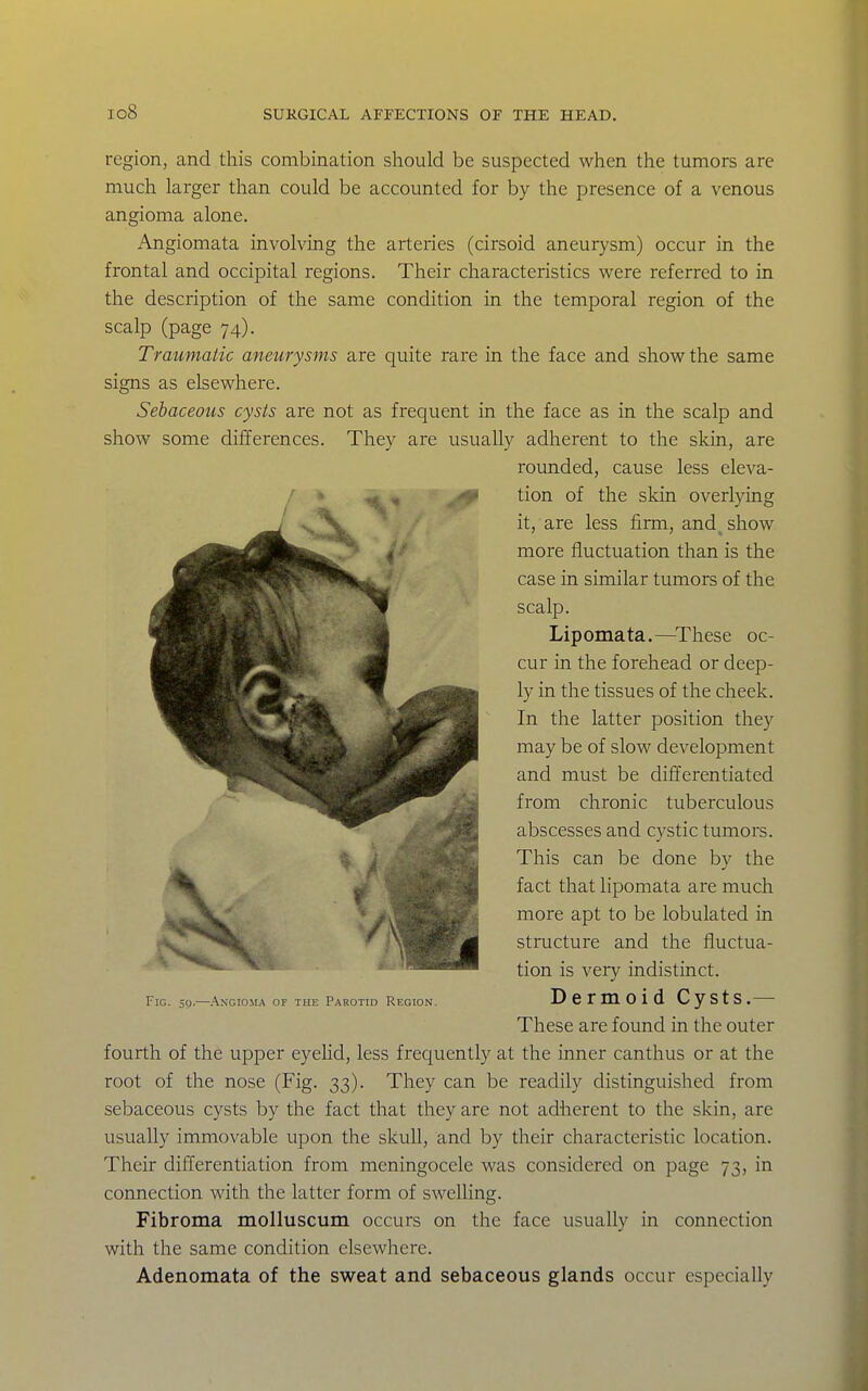 io8 region, and this combination should be suspected when the tumors are much larger than could be accounted for by the presence of a venous angioma alone. Angiomata involving the arteries (cirsoid aneurysm) occur in the frontal and occipital regions. Their characteristics were referred to in the description of the same condition in the temporal region of the scalp (page 74). Traumatic aneurysms are quite rare in the face and show the same signs as elsewhere. Sebaceous cysts are not as frequent in the face as in the scalp and show some differences. They are usually adherent to the skin, are fourth of the upper eyelid, less frequently at the inner canthus or at the root of the nose (Fig. 33). They can be readily distinguished from sebaceous cysts by the fact that they are not adherent to the skin, are usually immovable upon the skull, and by their characteristic location. Their differentiation from meningocele was considered on page 73, in connection with the latter form of swelling. Fibroma molluscum occurs on the face usually in connection with the same condition elsewhere. Adenomata of the sweat and sebaceous glands occur especially rounded, cause less eleva- tion of the skin overlying it, are less firm, and^ show more fluctuation than is the case in similar tumors of the scalp. Lipomata.—^These oc- cur in the forehead or deep- ly in the tissues of the cheek. In the latter position they may be of slow development and must be dilferentiated from chronic tuberculous abscesses and cystic tumors. This can be done by the fact that lipomata are much more apt to be lobulated in structure and the fluctua- tion is very indistinct. Fig. 59.—Angioma or the Parotid Region. Dermoid Cysts.— These are found in the outer