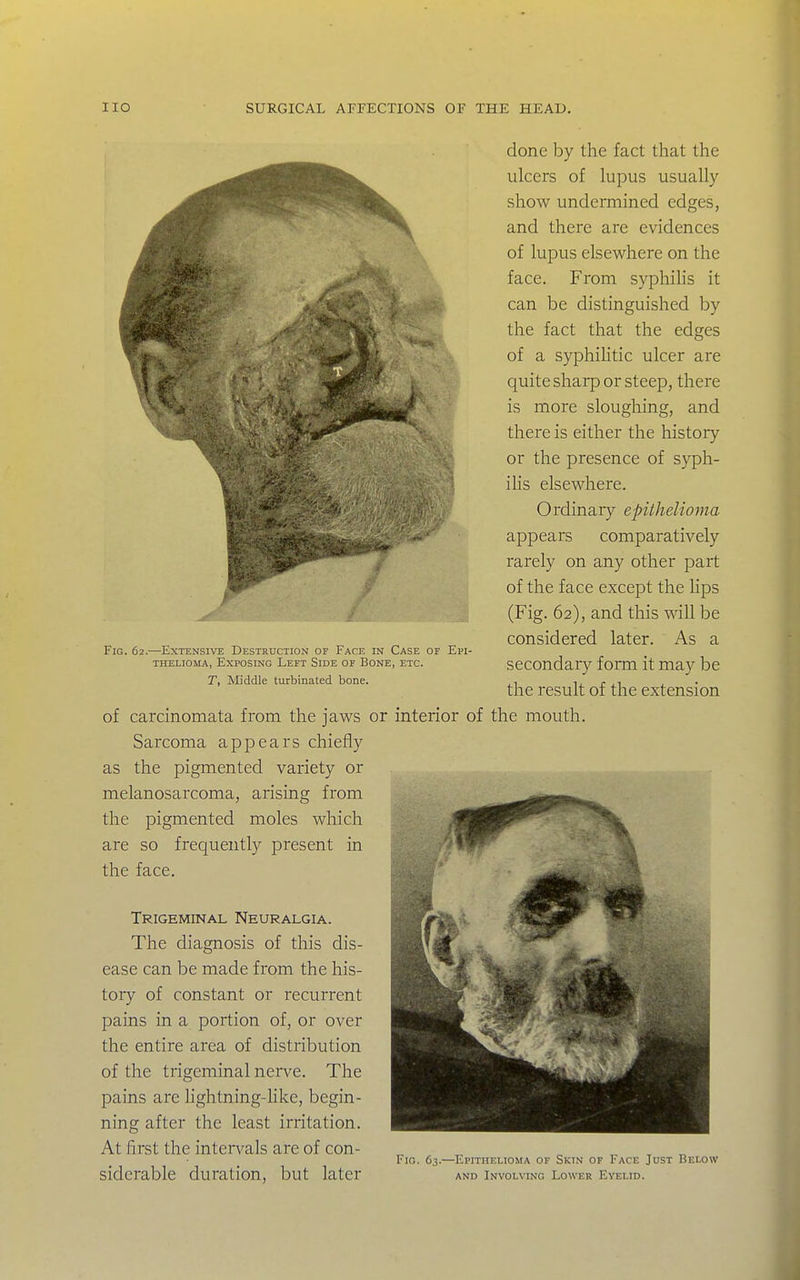 .ri^^M^-. ... ^ ■■ . ^ ..Mu Fig. 62.—Extensive Destruction of Face in Case of Epi- thelioma, Exposing Left Side of Bone, etc. r, Middle turbinated bone. of carcinomata from the jaws or interior of Sarcoma appears chiefly as the pigmented variety or melanosarcoma, arising from the pigmented moles which are so frequently present in the face. Trigeminal Neuralgia. The diagnosis of this dis- ease can be made from the his- tory of constant or recurrent pains in a portion of, or over the entire area of distribution of the trigeminal nerve. The pains are lightning-Hke, begin- ning after the least irritation. At first the intervals are of con- siderable duration, but later done by the fact that the ulcers of lupus usually show undermined edges, and there are evidences of lupus elsewhere on the face. From syphihs it can be distinguished by the fact that the edges of a syphihtic ulcer are quite sharp or steep, there is more sloughing, and there is either the history or the presence of syph- ihs elsewhere. Ordinary epithelioma appears comparatively rarely on any other part of the face except the hps (Fig. 62), and this will be considered later. As a secondary form it may be the result of the extension the mouth. Fig. 63.—Epithelioma of Skin of Face Just Below AND Involving Lower Eyelid.