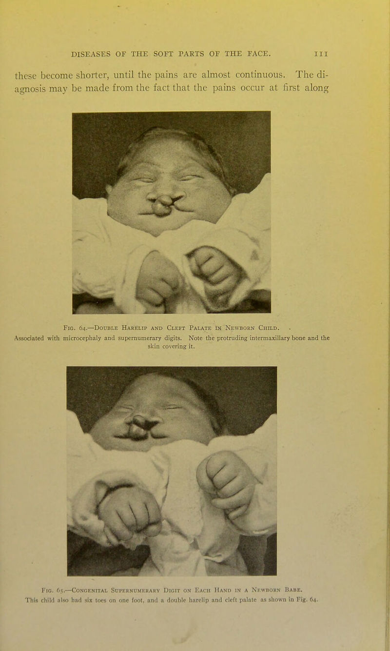 these become shorter, until the pains are almost continuous. The di- agnosis may be made from the fact that the pains occur at first along Fio. 65.—Congenital Supernumerary Digit on Each Hand in a Newhorn Uabe. This child niso had six toes on one toot, and a double harelip and cleft ixilato as shown in Fig. 64.