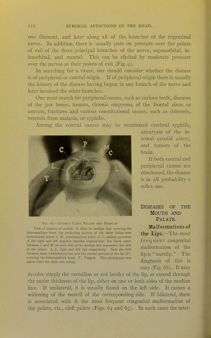 one filament, and later along all of the branches of the trigeminal nerve. In addition, there is usually pain on pressure over the points of exit of the three principal branches of the nerve, supraorbital, in- fraorbital, and mental. This can be elicited by moderate pressure over the nerves at their points of exit (Fig. 9). In searching for a cause, one should consider whether the disease is of peripheral or central origin. If of peripheral origin there is usually the history of the disease having begun in one branch of the ner\'e and later involved the other branches. One must search for peripheral causes, such as carious teeth, diseases of the jaw bones, tumors, chronic empyema of the frontal sinus or antrum, fractures an,d various constitutional causes, such as chlorosis, toxemia from malaria, or syphihs. Among the central causes may be mentioned cerebral syphihs, aneurysm of the in- ternal carotid arter}', and tumors of the brain. If both central and peripheral causes are ehminated, the disease is in all probabihty a reflex one. Diseases of the Mouth and Palate. Malformations of the Lips.—^The most frequent congenital malformation of the lipis harehp. The diagnosis of this is easy (Fig. 66). It may involve simply the vermihon or red border of the hp, or extend through the entire thickness of the Up, either on one or both sides of the median hne. If unilateral, it is usually found on the left side. It causes a widening of the nostril of the corresponding side. If bilateral, there is associated with it the most frequent congenital malformation of the palate, viz., cleft palate (Figs. 64 and 65). In such cases theinter- FiG. 66.—DonsLE Cleft Palate and Harelip. View of interior of mouth: P. Skin in median line covering the intermaxillary bone, the projecting portion of the latter being seen immediately below it; M, intermaxillary bone; C, C, palatal processes of the right and left superior maxillae respectively; the black space between C and M on each side of the median line represents the cleft in the palate; i, i, right and left lips respectively. Note the cleft between these rudimentary lips and the central portion of the lip (P), covering the intermaxillary bone. jT, Tongue. This photograph was taken while the child was crying.