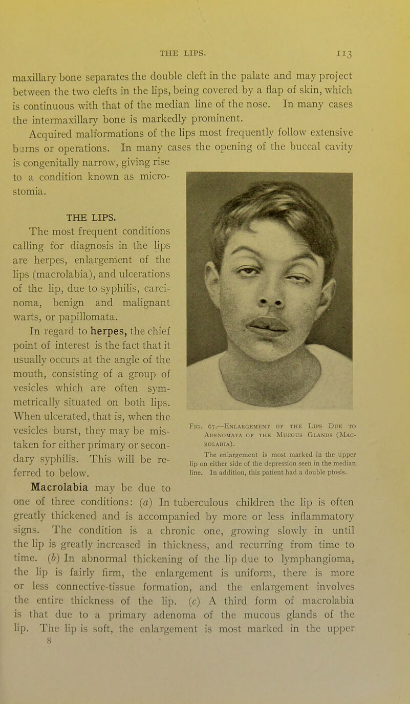 maxillary bone separates the double cleft in the palate and may project between the two clefts in the lips, being covered by a flap of skin, which is continuous with that of the median line of the nose. In many cases the intermaxillary bone is markedly prominent. Acquired malformations of the hps most frequently follow extensive burns or operations. In many cases the opening of the buccal cavity is congenitally narrow, giving rise to a condition known as micro- stomia. THE LIPS. The most frequent conditions calling for diagnosis in the hps are herpes, enlargement of the hps (macrolabia), and ulcerations of the Hp, due to syphihs, carci- noma, benign and mahgnant warts, or papillomata. In regard to herpes, the chief point of interest is the fact that it usuallv occurs at the ansrle of the mouth, consisting of a group of vesicles which are often sym- metrically situated on both lips. When ulcerated, that is, when the vesicles burst, they may be mis- taken for either primary or secon- dary syphihs. This will be re- ferred to below. Macrolabia may be due to one of three conditions: (a) In tuberculous children the hp is often greatly thickened and is accompanied by more or less inflammatoiy signs. The condition is a chronic one, growing slowly in until the lip is greatly increased in thicloiess, and recurring from time to time, (h) In abnormal thickening of the lip due to lymphangioma, the hp is fairly firm, the enlargement is uniform, there is more or less connective-tissue formation, and the enlargement involves the entire thickness of the lip. (c) A third form of macrolabia is that due to a primary adenoma of the mucous glands of the lip. The li[) is soft, the enlargement is most marked in the upper 8 Fin. 67.—Enlargement of the Lips Due to Adenomata or the Mucous Glands (Mac- rolabia). The enlargement is most marked in the upper lip on either side of the depression seen in the median line. In addition, this patient had a double ptosis.