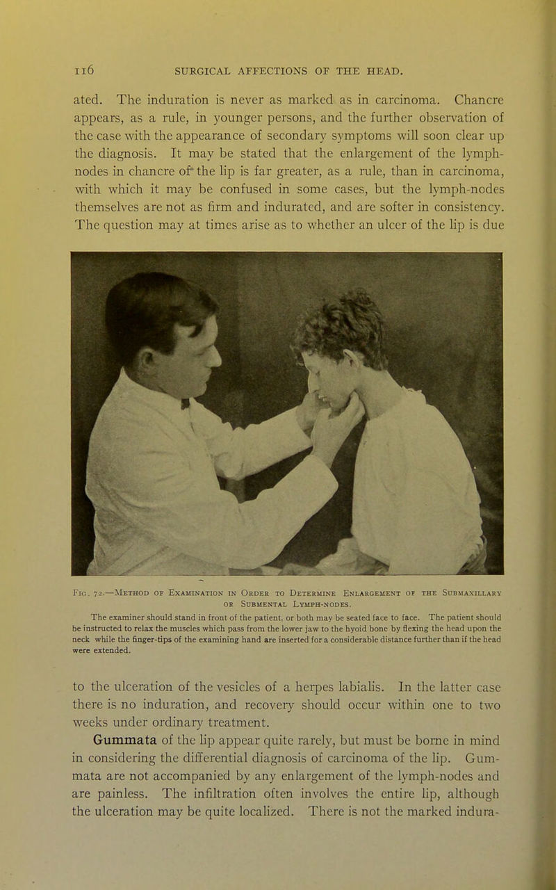 ated. The induration is never as marked as in carcinoma. Chancre appears, as a rule, in younger persons, and the further obser\'ation of the case with the appearance of secondary symptoms will soon clear up the diagnosis. It may be stated that the enlargement of the lymph- nodes in chancre of* the Up is far greater, as a rule, than in carcinoma, with which it may be confused in some cases, but the lymph-nodes themselves are not as firm and indurated, and are softer in consistency. The question may at times arise as to whether an ulcer of the Hp is due Fio. 72.—Method of Examination in Urder to Determine Enlargement of the Submaxillary OR Submental Lymph-nodes. The examiner should stand in front of the patient, or both may be seated face to face. The patient should be instructed to relax the muscles which pass from the lower jaw to the hyoid bone by flexing the head upon the neck while the finger-tips of the examining hand are inserted for a considerable distance further than if the head were extended. to the ulceration of the vesicles of a herpes labiahs. In the latter case there is no induration, and recovery should occur within one to two weeks under ordinar}' treatment. Gummata of the Hp appear quite rarely, but must be borne in mind in considering the differential diagnosis of carcinoma of the Hp. Gum- mata are not accompanied by any enlargement of the lymph-nodes and are painless. The infiltration often involves the entire Hp, although the ulceration may be quite localized. There is not the marked indura-