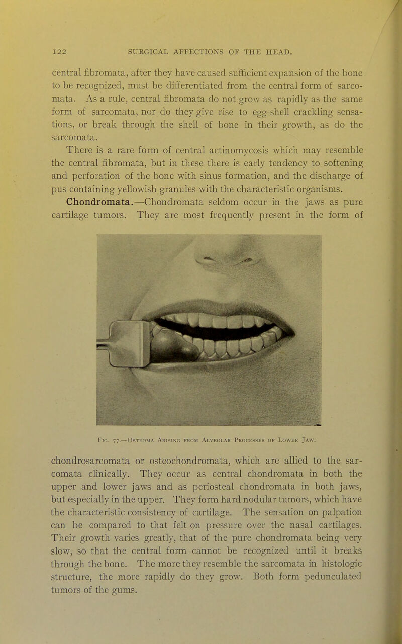 central fibromata, after they have caused suflicient expansion of the bone to be recognized, must be dilTerentiated from the central form of sarco- mata. As a rule, central fibromata do not grow as rapidly as the same form of sarcomata, nor do they give rise to egg-shell crackling sensa- tions, or break through the shell of bone in their growth, as do the sarcomata. There is a rare form of central actinomycosis which may resemble the central fibromata, but in these there is early tendency to softening and perforation of the bone with sinus formation, and the discharge of pus containing yellowish granules with the characteristic organisms. Chondromata.—Chondromata seldom occur in the jaws as pure cartilage tumors. They are most frequently present in the form of Fir,. 77.—Osteoma Arising from Alveolar Processes of Lower Jaw. chondrosarcomata or osteochondromata, which are allied to the sar- comata clinically. They occur as central chondromata in both the upper and lower jaws and as periosteal chondromata in both jaws, but especially in the upper. They form hard nodular tumors, which have the characteristic consistency of cartilage. The sensation on palpation can be compared to that felt on pressure over the nasal cartilages. Their growth varies greatly, that of the pure chondromata being very slow, so that the central form cannot be recognized until it breaks through the bone. The more they resemble the sarcomata in histologic structure, the more rapidly do they grow. Both form pedunculated tumors of the gums.