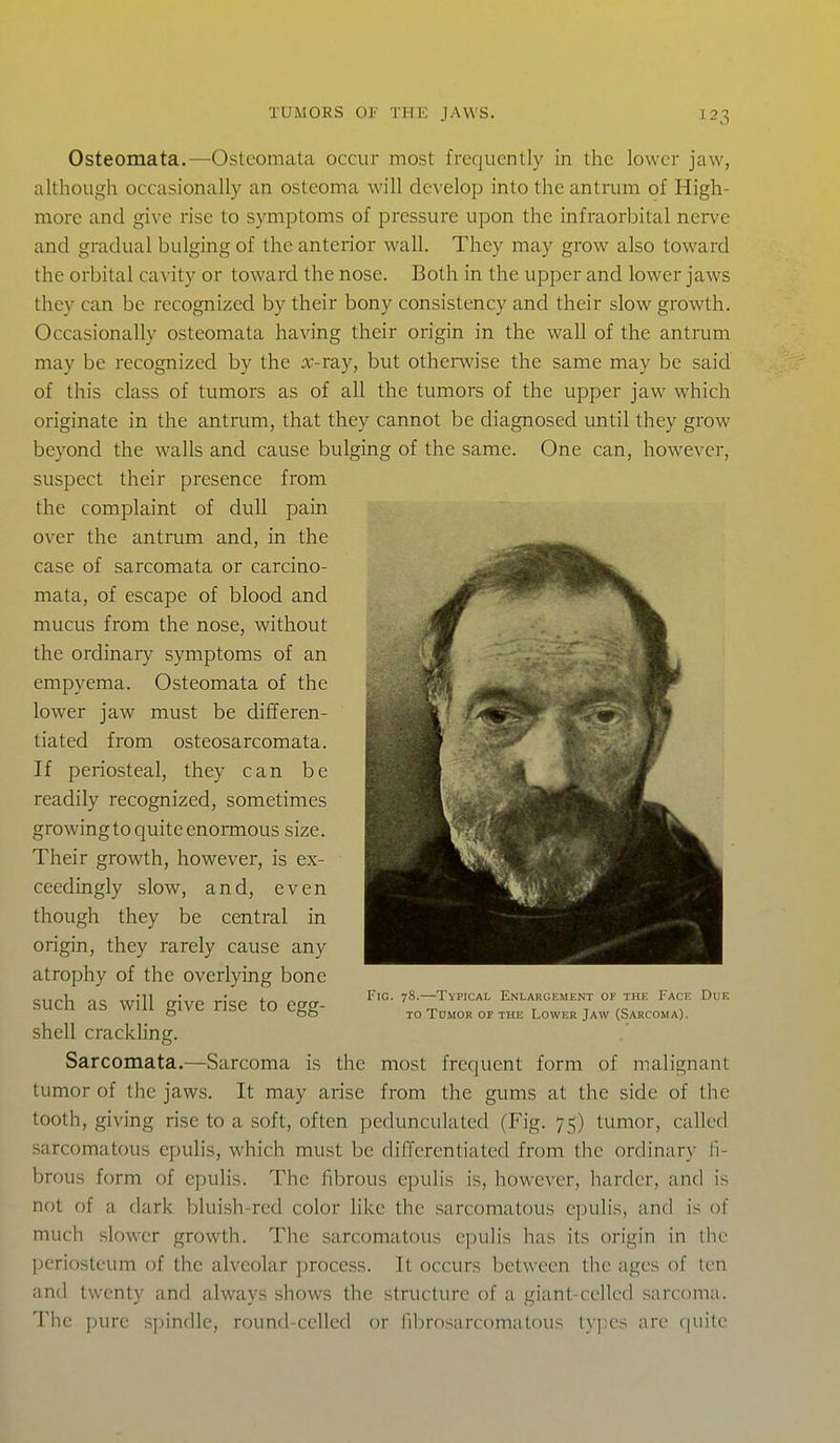 Osteomata.—Osteomata occur most frequently in the lower jaw, although occasionally an osteoma will develop into the antrum of High- more and give rise to symptoms of pressure upon the infraorbital nerve and gradual bulging of the anterior wall. They may grow also toward the orbital cavity or toward the nose. Both in the upper and lower jaws they can be recognized by their bony consistency and their slow growth. Occasionally osteomata having their origin in the wall of the antrum may be recognized by the x-ra.y, but otherwise the same may be said of this class of tumors as of all the tumors of the upper jaw which originate in the antrum, that they cannot be diagnosed until they grow beyond the walls and cause bulging of the same. One can, however, suspect their presence from the complaint of dull pain over the antrum and, in the case of sarcomata or carcino- mata, of escape of blood and mucus from the nose, without the ordinary symptoms of an empyema. Osteomata of the lower jaw must be differen- tiated from osteosarcomata. If periosteal, they can be readily recognized, sometimes growing to quite enormous size. Their growth, however, is ex- ceedingly slow, and, even though they be central in origin, they rarely cause any atrophy of the overlying bone such as will give rise to egg- shell crackling. Sarcomata.—Sarcoma is the most frequent form of malignant tumor of the jaws. It may arise from the gums at the side of the tooth, giving rise to a soft, often pedunculated (Fig. 75) tumor, called sarcomatous epulis, which must be differentiated from the ordinary fi- brous form of epuHs. The fibrous epulis is, however, harder, and is not of a dark bluish-red color like the sarcomatous epulis, and is of much slower growth. The sarcomatous epulis has its origin in the periosteum of the alveolar process. It occurs between the ages of ten and twenty and always shows the structure of a giant-celled sarcoma. The pnirc spindle, round-celled or fibrosarcomatous types arc (|uile Fig. 78.—Typical Enlargement of the Face Due TO Tdmok of the Lower Jaw (Sarcoma).