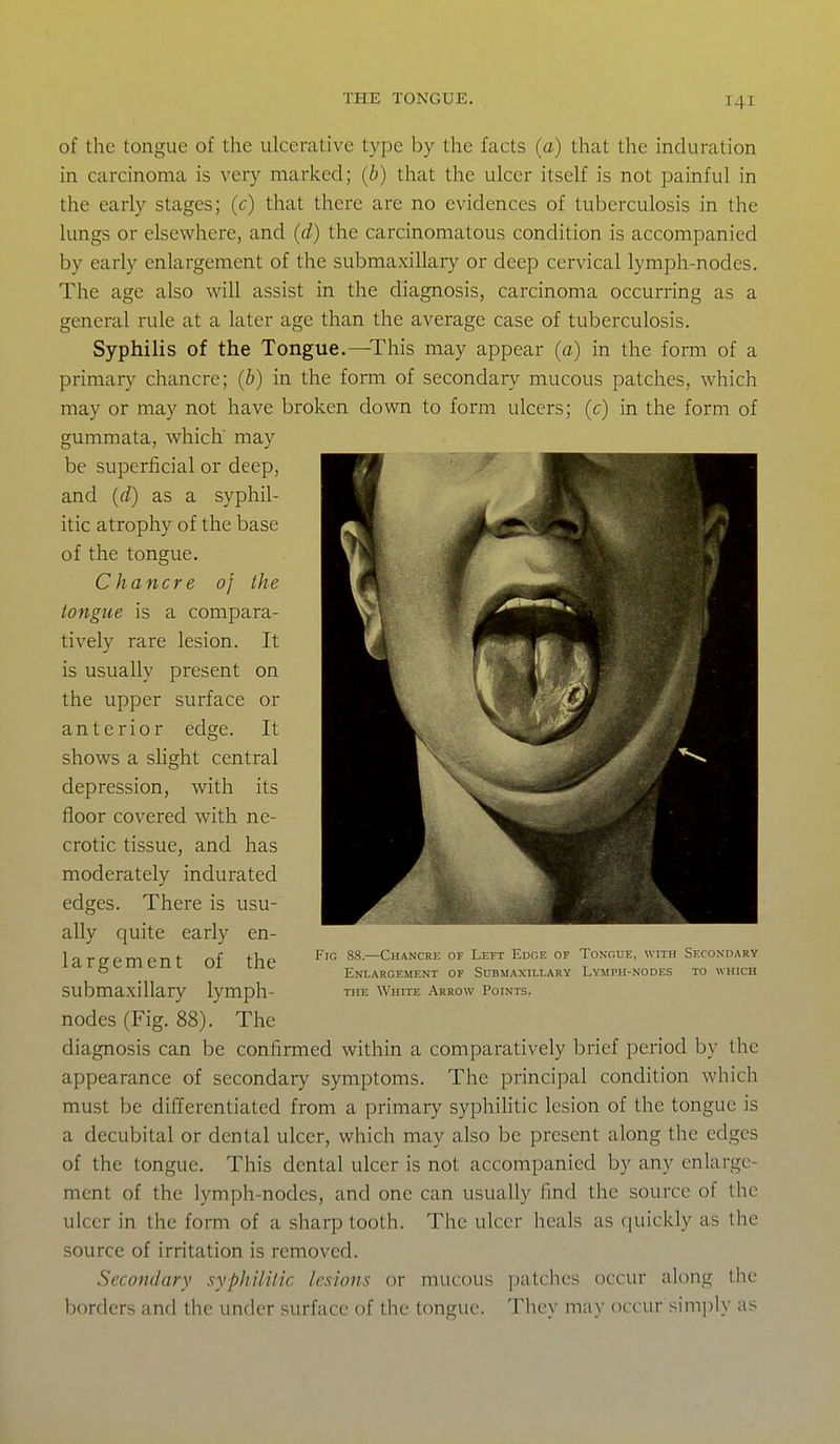 of the tongue of the ulcerative type by the facts (a) that the induration in carcinoma is very marked; (6) that the ulcer itself is not painful in the early stages; (c) that there are no evidences of tuberculosis in the lungs or elsewhere, and (d) the carcinomatous condition is accompanied by early enlargement of the submaxillary or deep cervical lymph-nodes. The age also will assist in the diagnosis, carcinoma occurring as a general rule at a later age than the average case of tuberculosis. Syphilis of the Tongue.—^This may appear (a) in the form of a primary chancre; (b) in the form of secondary mucous patches, which may or may not have broken down to form ulcers; (c) in the form of gummata, which may be superficial or deep, and (d) as a syphil- itic atrophy of the base of the tongue. Chancre of the tongue is a compara- tively rare lesion. It is usually present on the upper surface or anterior edge. It shows a shght central depression, with its floor covered with ne- crotic tissue, and has moderately indurated edges. There is usu- ally quite early en- largement of the submaxillary lymph- nodes (Fig. 88). The diagnosis can be confirmed within a comparatively brief period by the appearance of secondary symptoms. The principal condition which must be differentiated from a primary syphihtic lesion of the tongue is a decubital or dental ulcer, which may also be present along the edges of the tongue. This dental ulcer is not accompanied by any enlarge- ment of the lymph-nodes, and one can usually find the source of the ulcer in the form of a sharp tooth. The ulcer heals as quickly as the source of irritation is removed. Secondary syphilitic lesions or mucous patches occur along the borders and the under surface of the tongue. They may occur sim])ly as Fig 88.—Chancre of Left Edge of Tongue, with Secondary Enlargement of Submaxillary Lymph-nodes to which THE White Arrow Points.