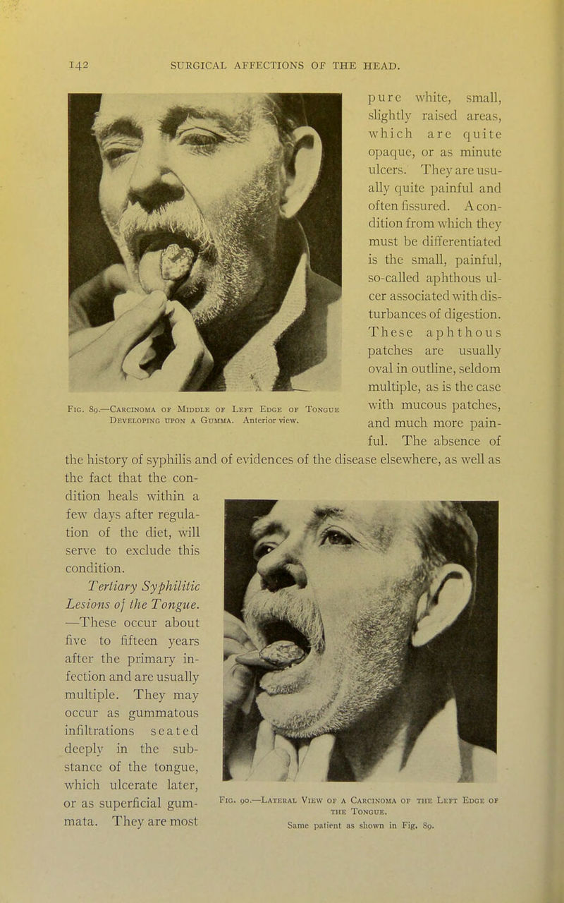 Fig. 80.—Carcinoma of Middle of Left Edge of Tongde Developing upon a Gumma. Anterior view. ]j u r c white, small, .slightly raised areas, w h i c li are quite opaque, or as minute J*^ ulcers. They are usu- ^ ally quite painful and f^^fl^^ '  ^^^H often fissured. A con- dition from which they must be differentiated is the small, painful, so-called aphthous ul- cer associated with dis- MMjk turbances of digestion. ^I^H ^^^^^^r .j^^^K These aphthous ^„^^^r ^^^^B patches are usually ^ J^^T ^^^r oval in outline, seldom multiple, as is the case with mucous patches, and much more pain- ful. The absence of the history of syphilis and of evidences of the disease elsewhere, as well as the fact that the con- dition heals within a few days after regula- tion of the diet, will serve to exclude this condition. Tertiary Syphilitic Lesions 0} the Tongue. —These occur about five to fifteen years after the primary in- fection and are usually multiple. They may occur as gummatous infiltrations seated deeply in the sub- stance of the tongue, which ulcerate later, or as SUDerficial cum- —Lateral view of a Carcinoma of the Left Edge of the Tongue. mata. They are most s.ime patient as shown in Fig. 89.