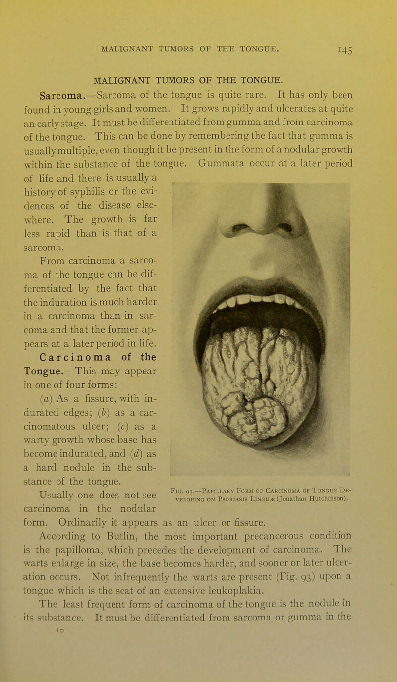 MALIGNANT TUMORS OF THE TONGUE. Sarcoma.—Sarcoma of the tongue is quite rare. It has only been found in young girls and women. It grows rapidly and ulcerates at quite an early stage. It must be differentiated from gumma and from carcinoma of the tongue. This can be done by remembering the fact that gumma is usually multiple, even though it be present in the form of a nodular growth within the substance of the tongue. Gummata occur at a later period of life and there is usually a history of syphihs or the evi- dences of the disease else- where. The growth is far less rapid than is that of a sarcoma. From carcinoma a sarco- ma of the tongue can be dif- ferentiated by the fact that the induration is much harder in a carcinoma than in sar- coma and that the former ap- pears at a later period in hfe. Carcinoma of the Tongue.—This may appear in one of four forms: (a) As a fissure, with in- durated edges; (b) as a car- cinomatous ulcer; (c) as a warty growth whose base has become indurated, and (d) as a hard nodule in the sub- stance of the tongue. Usually one does not see carcinoma in the nodular form. Ordinarily it appears as an ulcer or fissure. According to Butlin, the most important precancerous condition is the papilloma, which precedes the development of carcinoma. The warts enlarge in size, the base becomes harder, and sooner or later ulcer- ation occurs. Not infrequently the warts are present (Fig. 93) upon a tongue which is the seat of an extensive leukoplakia. The least frequent form of carcinoma of the tongue is the nodule in its substance. It must be differentiated froni sarcoma or gumma in the Fig. 1)3.—Papillary 1okm or Carcinoma of Tongue De- veloping ON Psoriasis Lingu.e (Jonallian Hutchinson). 10