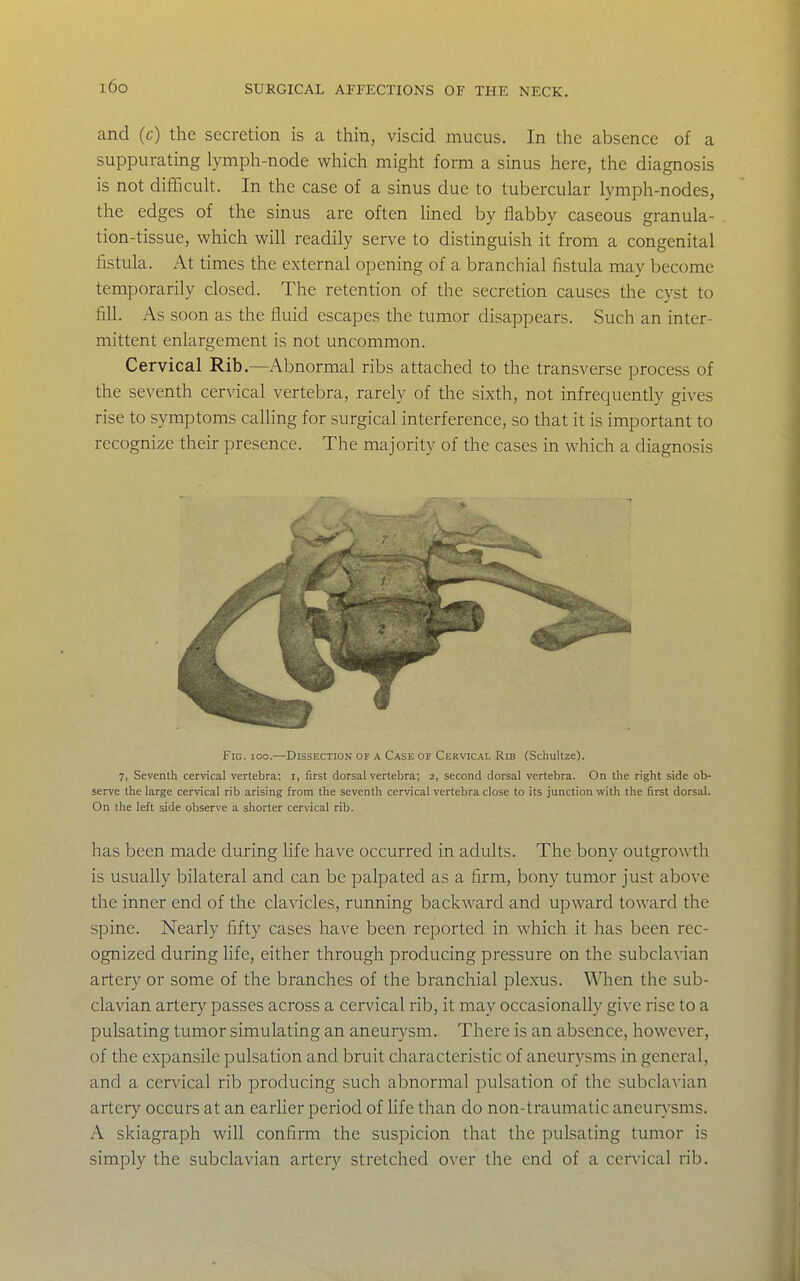 and (c) the secretion is a thin, viscid mucus. In the absence of a suppurating lymph-node which might form a sinus here, the diagnosis is not difficult. In the case of a sinus due to tubercular lymph-nodes, the edges of the sinus are often lined by flabby caseous granula- tion-tissue, which will readily serve to distinguish it from a congenital fistula. At times the external opening of a branchial fistula may become temporarily closed. The retention of the secretion causes the cyst to fill. As soon as the fluid escapes the tumor disappears. Such an inter- mittent enlargement is not uncommon. Cervical Rib.—Abnormal ribs attached to the transverse process of the seventh cervical vertebra, rarely of the sixth, not infrequently gives rise to symptoms calling for surgical interference, so that it is important to recognize their presence. The majority of the cases in which a diagnosis Fig. ioo.—Dissection of a Case of Cervical Rib (Schultze). 7, Seventh cervical vertebra; i, first dorsal vertebra; 2, second dorsal vertebra. On the right side ob- serve the large cervical rib arising from the seventh cervical vertebra close to its junction with the first dorsal. On the left side observe a shorter cervical rib. has been made during life have occurred in adults. The bony outgrowth is usually bilateral and can be palpated as a firm, bony tumor just above the inner end of the clavicles, running backward and upward toward the spine. Nearly fifty cases have been reported in which it has been rec- ognized during life, either through producing pressure on the subclavian artery or some of the branches of the branchial plexus. When the sub- clavian artery passes across a cervical rib, it may occasionally give rise to a pulsating tumor simulating an aneurysm. There is an absence, however, of the expansile pulsation and bruit characteristic of aneurysms in general, and a cervical rib producing such abnormal pulsation of the subcla\-ian artery occurs at an earlier period of Ufe than do non-traumatic aneurysms. A skiagraph will confirm the suspicion that the pulsating tumor is simply the subclavian artery stretched over the end of a cervical rib.