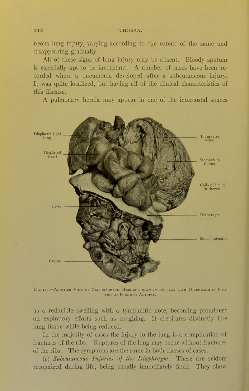 neous lung injury, varying according to the extent of the same and disappearing gradually. All of these signs of lung injury may be absent. Bloody sputum is especially apt to be inconstant. A number of cases have been re- corded M^here a pneumonia developed after a subcutaneous injury. It was quite localized, but having all of the clinical characteristics of this disease. A pulmonary hernia may appear in one of the intercostal spaces Transverse colon Stomach in thorax Coils of ileum in thorax Diaphragm Small intestine I'ic. 145.—Another View of Diaphragmatic Hernia shown in Fig. 144 with Diaphragm in Posi- tion AS Found at Autopsy. as a reducible swelling with a tympanitic note, becoming prominent on expiratory efforts such as coughing. It crepitates distinctly like lung tissue while being reduced. In the majority of cases the injury to the lung is a compHcation of fractures of the ribs. Ruptures of the lung may occur without fractures of the ribs. The symptoms are the same in both classes of cases. (c) Subcutaneous Injuries of the Diaphragm.—These are seldom recognized during life, being usually immediately fatal. They show