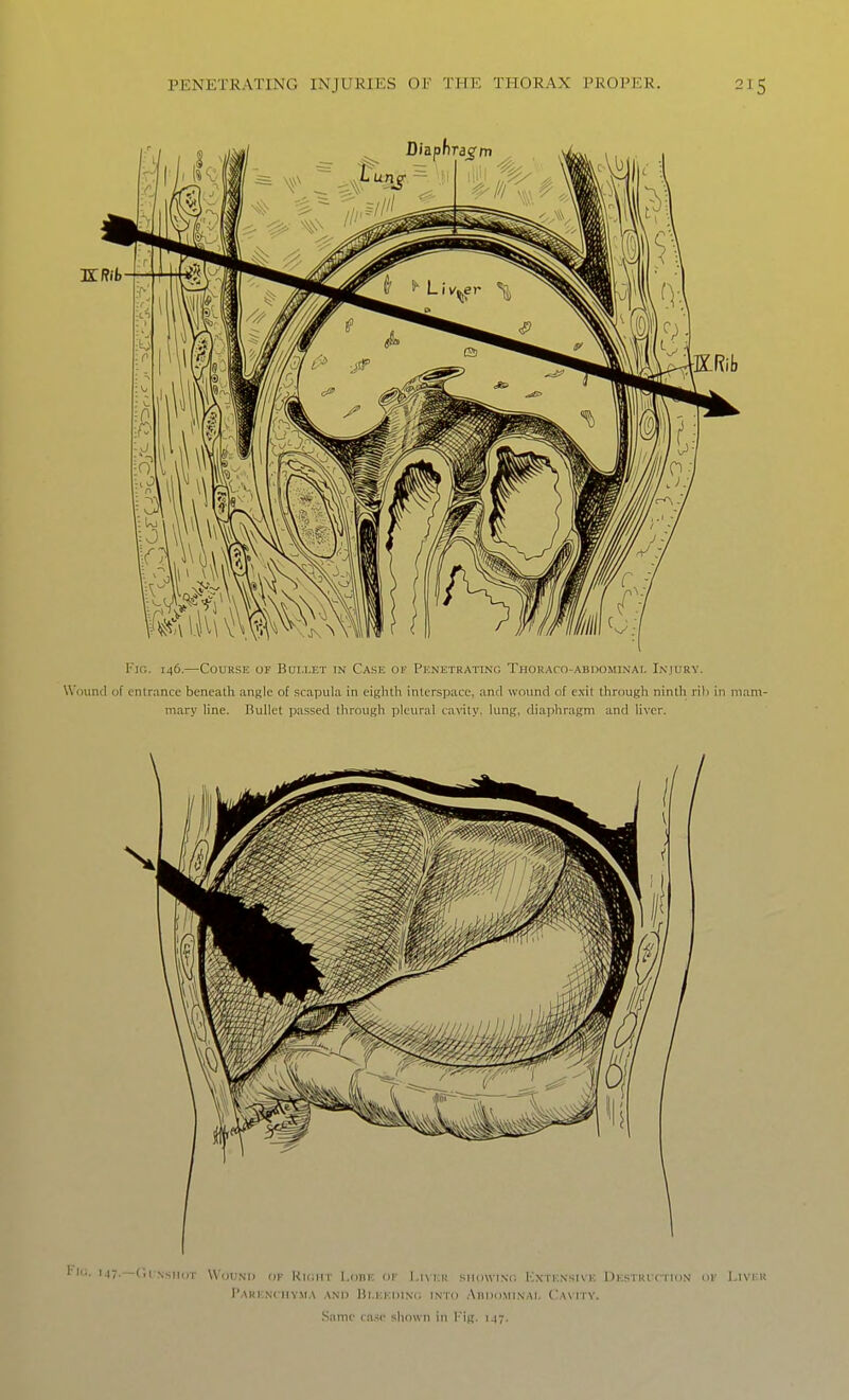 I'lo. 146.—Course of Bui.i.et in Cake of Penetrating THORAro-ABDOMiNAt. Injury. Wound of cnlr.mce beneath .ingle of scapula in eighth interspace, and wound of exit through ninth rili in mam- mary line. Bullet passed through pleural cavity, lung, diaphragm and liver.