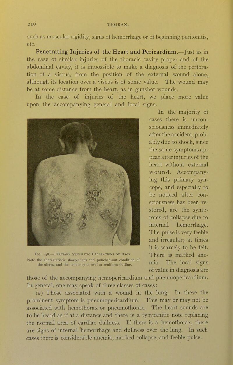 such as muscular rigidity, signs of hemorrhage or of beginning peritonitis, etc. Penetrating Injuries of the Heart and Pericardium.—Just as in the case of similar injuries of the thoracic cavity proper and of the abdominal cavity, it is impossible to make a diagnosis of the perfora- tion of a viscus, from the position of the external wound alone, although its location over a viscus is of some value. The wound may be at some distance from the heart, as in gunshot wounds. In the case of injuries of the heart, we place more value upon the accompanying general and local signs. In the majority of those of the accompanying hemopericardium and pneumopericardium. In general, one may speak of three classes of cases: (a) Those associated with a wound in the lung. In these the prominent symptom is pneumopericardium. This may or may not be associated with hemothorax or pneumothorax. The heart sounds are to be heard as if at a distance and there is a tympanitic note replacing the normal area of cardiac dullness. If there is a hemothorax, there are signs of internal hemorrhage and dullness over the lung. In such cases there is considerable anemia, marked collapse, and feeble pulse. Fig. 148.—Tertiary Syi'hilitic Ulcerations of Back Note the characteristic sharp edges and punched-out condition of the ulcers, and the tendency to oval or rcniform outline. cases there is uncon- sciousness immediately after the accident, prob- ably due to shock, since the same symptoms ap- pear after injuries of the heart without external wound. Accompany- ing this primary syn- cope, and especially to be noticed after con- sciousness has been re- stored, are the symp- toms of collapse due to internal hemorrhage. The pulse is very feeble and irregular; at times it is scarcely to be felt. There is marked ane- mia. The local signs of value in diagnosis are