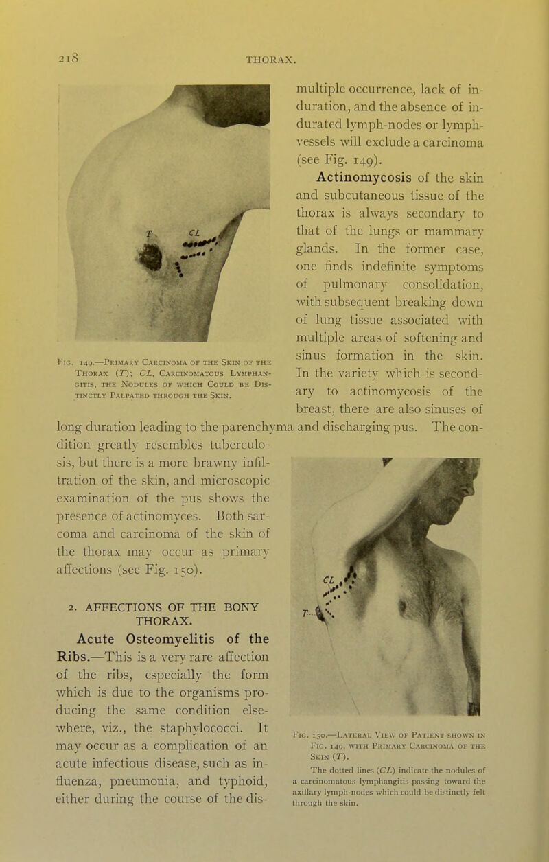 CL 4' I'lc. 149.—Primary Carcinoma of the Skin of the Thorax [.T)\ CL, Carcinomatous Lymphan- gitis, THE Nodules of which Could be Dis- tinctly Palpated through the Skin. long duration leading to the parenchyma dition greatly resembles tuberculo- sis, but there is a more brawny infil- tration of the skin, and microscopic examination of the pus shows the presence of actinomyces. Both sar- coma and carcinoma of the skin of the thorax may occur as primary affections (see Fig. 150). 2. AFFECTIONS OF THE BONY THORAX. Acute Osteomyelitis of the Ribs.—This is a very rare affection of the ribs, especially the form which is due to the organisms pro- ducing the same condition else- where, viz., the staphylococci. It may occur as a complication of an acute infectious disease, such as in- tluenza, pneumonia, and typhoid, multiple occurrence, lack of in- duration, and the absence of in- durated lymph-nodes or lymph- vessels will exclude a carcinoma (see Fig. 149). Actinomycosis of the skin and subcutaneous tissue of the thorax is always secondary to that of the lungs or mammary glands. In the former case, one finds indefinite symptoms of pulmonary consolidation, with subsequent breaking down of lung tissue associated with multiple areas of softening and sinus formation in the skin. In the variety which is second- ary to actinomycosis of the breast, there are also sinuses of and discharging pus. The con- either during the course of the dis- FiG. 150.—Lateral \ie\v of Patient shown in Fic. I4g, WITH Primary Carcinoma of the Skin (T). The clotted lines {CL) indicate the nodules of a carcinomatous lymphangitis passing toward the axillary lymph-nodes which could be distinctly felt through the skin.