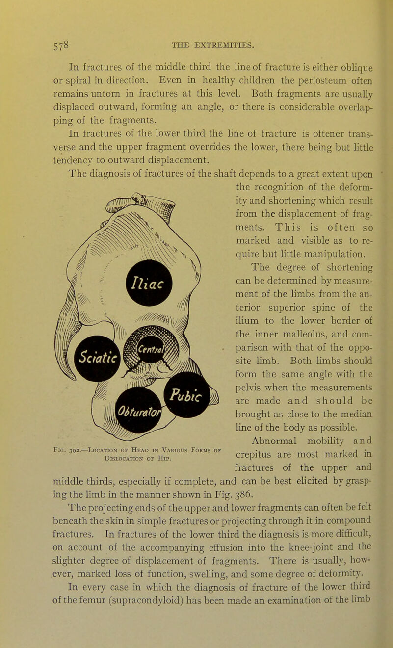 In fractures of the middle third the line of fracture is either oblique or spiral in direction. Even in healthy children the periosteum often remains untorn in fractures at this level. Both fragments are usually displaced outward, forming an angle, or there is considerable overlap- ping of the fragments. In fractures of the lower third the hne of fracture is oftener trans- verse and the upper fragment overrides the lower, there being but Httle tendency to outward displacement. The diagnosis of fractures of the shaft depends to a great extent upon middle thirds, especially if complete, and can be best ehcited by grasp- ing the limb in the manner shown in Fig. 386. The projecting ends of the upper and lower fragments can often be felt beneath the skin in simple fractures or projecting through it in compound fractures. In fractures of the lower third the diagnosis is more difiicult, on account of the accompanying effusion into the knee-joint and the slighter degree of displacement of fragments. There is usually, how- ever, marked loss of function, swelling, and some degree of deformity. In every case in which the diagnosis of fracture of the lower third of the femur (supracondyloid) has been made an e.xamination of the hmb the recognition of the deform- ity and shortening which result from the displacement of frag- ments. This is often so marked and visible as to re- quire but little manipulation. The degree of shortening can be determined by measure- ment of the limbs from the an- terior superior spine of the ihum to the lower border of the inner malleolus, and com- parison with that of the oppo- site limb. Both hmbs should form the same angle with the pelvis when the measurements are made and should be brought as close to the median line of the body as possible. Fig. 392.—Location of Head in Various Forms of Dislocation of Hip. Abnormal mobility and crepitus are most marked in fractures of the upper and