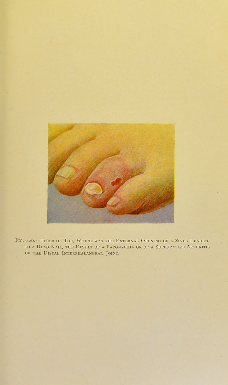 Fig. 426.—Ulcer of Toe, Which was the External Opening of a Sinus Leading TO A Dead Nail, the Result of a Paronychia or of a Suppurative Arthritis OF THE Distal Interphalangeal Joint.