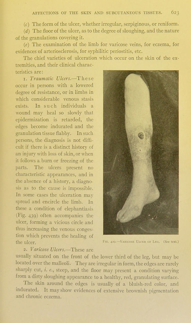 (c) The form of the ulcer, whether irregular, serpiginous, or reniform. (d) The floor of the ulcer, as to the degree of sloughing, and the nature of the granulations covering it. (e) The examination of the limb for varicose veins, for eczema, for evidences of arteriosclerosis, for syphihtic periostitis, etc. The chief varieties of ulceration which occur on the skin of the ex- tremities, and their cUnical charac- teristics are: 1. Traumaiic Ulcers.—These occur in persons with a lowered degree of resistance, or in limbs in which considerable venous stasis exists. In such individuals a wound may heal so slowly that epidermization is retarded, the edges become indurated and the granulation tissue flabby. In such persons, the diagnosis is not diffi- cult if there is a distinct history of an injury with loss of skin, or when it follows a burn or freezing of the parts. The ulcers present no characteristic appearances, and in the absence of a history, a diagno- sis as to the cause is impossible. In some cases the ulceration may spread and encircle the Hmb. In these a condition of elephantiasis (Fig. 439) often accompanies the ulcer, forming a vicious circle and thus increasing the venous conges- tion which prevents the healing of the ulcer. 2. Varicose Ulcers.—These are usually situated on the front of the lower third of the leg, but may be located over the malleoli. They are irregular in form, the edges are rarely sharply cut, i. e., steep, and the floor may present a condition varying from a dirty sloughing appearance to a healthy, red, granulating surface. The skin around the edges is usually of a bluish-red color, and indurated. It may show evidences of extensive brownish ]iigmcntalion and chronic eczema. Fig. 421).—Vakicosk Ui.cicr of Leo. (See text.)