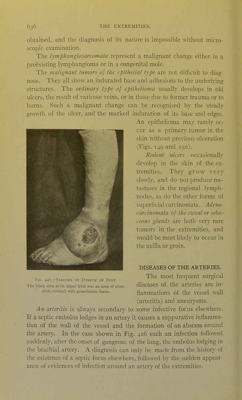 obtained, and the diagnosis of its nature is impossible without micro- scopic examination. The lymphangiosarcomala represent a malignant change either in a preexisting lymphangioma or in a congenital mole. The malignanl lumors 0} the epithelial type arc not difficult to diag- nose. They all show an indurated base and adhesions to the underlying structures. The ordinary type of epiihelioma usually develops in old ulcers, the result of varicose veins, or in those due to former trauma or to burns. Such a mahgnant change can be recognized by the steady growth of the ulcer, and the marked induration of its base and edges. An epithelioma may rarely oc- cur as a primary tumor in the skin without previous ulceration (Figs. 149 and 150). Rodent ulcers occasionally develop in the skin of the ex- tremities. They grow very slowly, and do not produce me- tastases in the regional lymph- nodes, as do the other forms of superficial carcinomata. Adeno- carcinomata of the sweat or seba- ceous glands are both very rare tumors in the extremities, and would be most Kkely to occur in the axilla or groin. DISEASES OF THE ARTERIES. , ^ The most frequent surgical riG. 446.—Sarcoma of Dorsum or Foot. The black area at its upper level was an area of ulcer- disCaSCS Of tllC arteriCS are m- ation covered with granulation tissue. flammationS of the VCSScl Wall (arteritis) and aneurysms. An arteritis is always secondary to some infective focus elsewhere. If a septic embolus lodges in an artery it causes a suppurative inflamma- tion of the wall of the vessel and the formation of an abscess around the artery. In the case shown in Fig. 426 such an infection followed suddenly, after the onset of gangrene of the lung, the embolus lodging in the brachial artery. A diagnosis can only be made from the history of tlie existence of a septic focus elsewhere, followed by the sudden appear- ance of evidences of infection around an artery of the extremities.