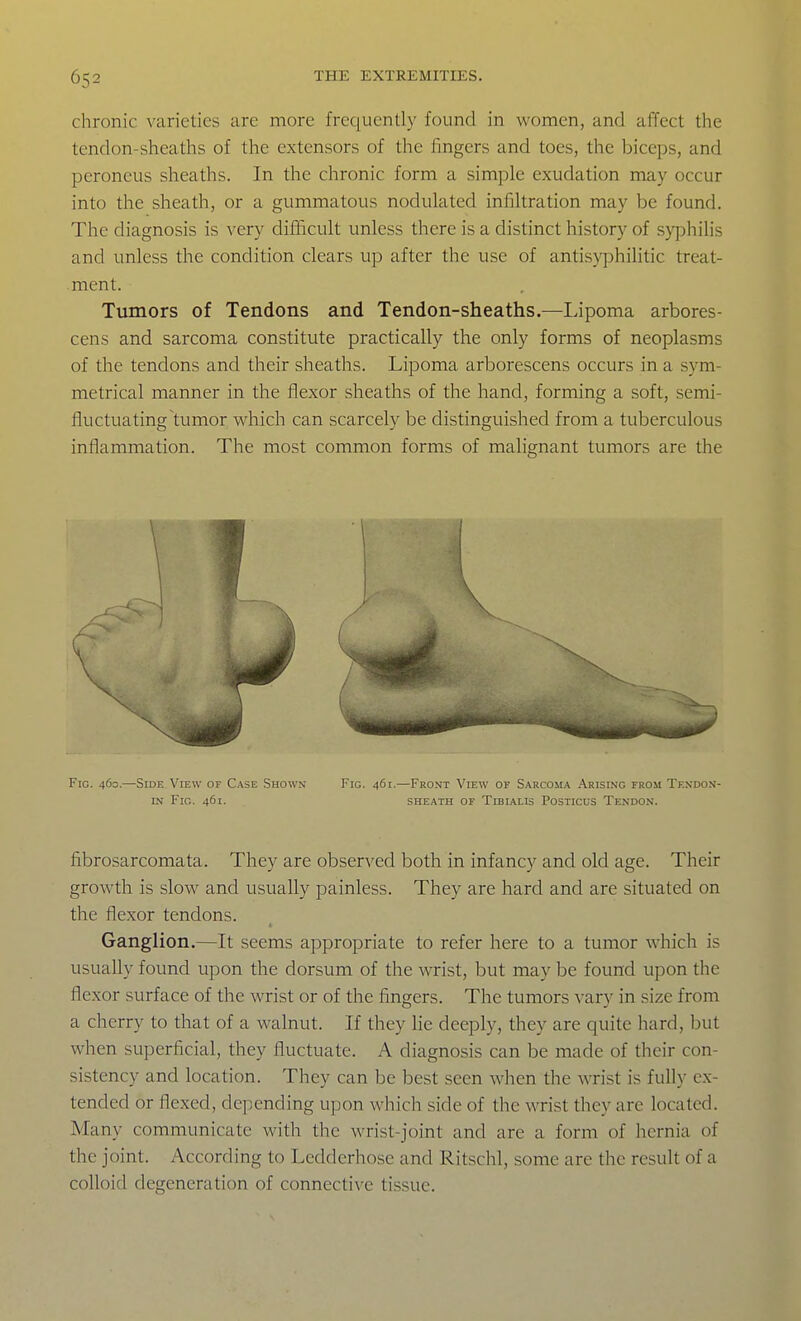 chronic varieties are more frequently found in women, and affect the tendon-sheaths of the extensors of the fingers and toes, the biceps, and peroneus sheaths. In the chronic form a simple exudation may occur into the sheath, or a gummatous nodulated infiltration may be found. The diagnosis is very difficult unless there is a distinct history of syphilis and unless the condition clears up after the use of antisyphilitic treat- ment. Tumors of Tendons and Tendon-sheaths.—Lipoma arbores- cens and sarcoma constitute practically the only forms of neoplasms of the tendons and their sheaths. Lipoma arborescens occurs in a sym- metrical manner in the flexor sheaths of the hand, forming a soft, semi- fluctuating tumor which can scarcely be distinguished from a tuberculous inflammation. The most common forms of malignant tumors are the Fig. 460.—-Side Vievv of Case Shown Fig. 461.—Front View of S.\rcosi.\ Arising from Tf.ndon- LN Fig. 461. SHEATH of Tibialis Posticus Tendon. fibrosarcomata. They are observed both in infancy and old age. Their growth is slow and usually painless. They are hard and are situated on the flexor tendons. Ganglion.—It seems appropriate to refer here to a tumor which is usually found upon the dorsum of the wrist, but may be found upon the flexor surface of the wrist or of the fingers. The tumors varv in size from a cherry to that of a walnut. If they lie deeply, they are quite hard, but when superficial, they fluctuate. A diagnosis can be made of their con- sistency and location. They can be best seen when the wrist is fully ex- tended or flexed, depending upon which side of the wist they are located. Many communicate with the wrist-joint and are a form of hernia of the joint. According to Ledderhose and Ritschl, some are the result of a colloid degeneration of connective tissue.