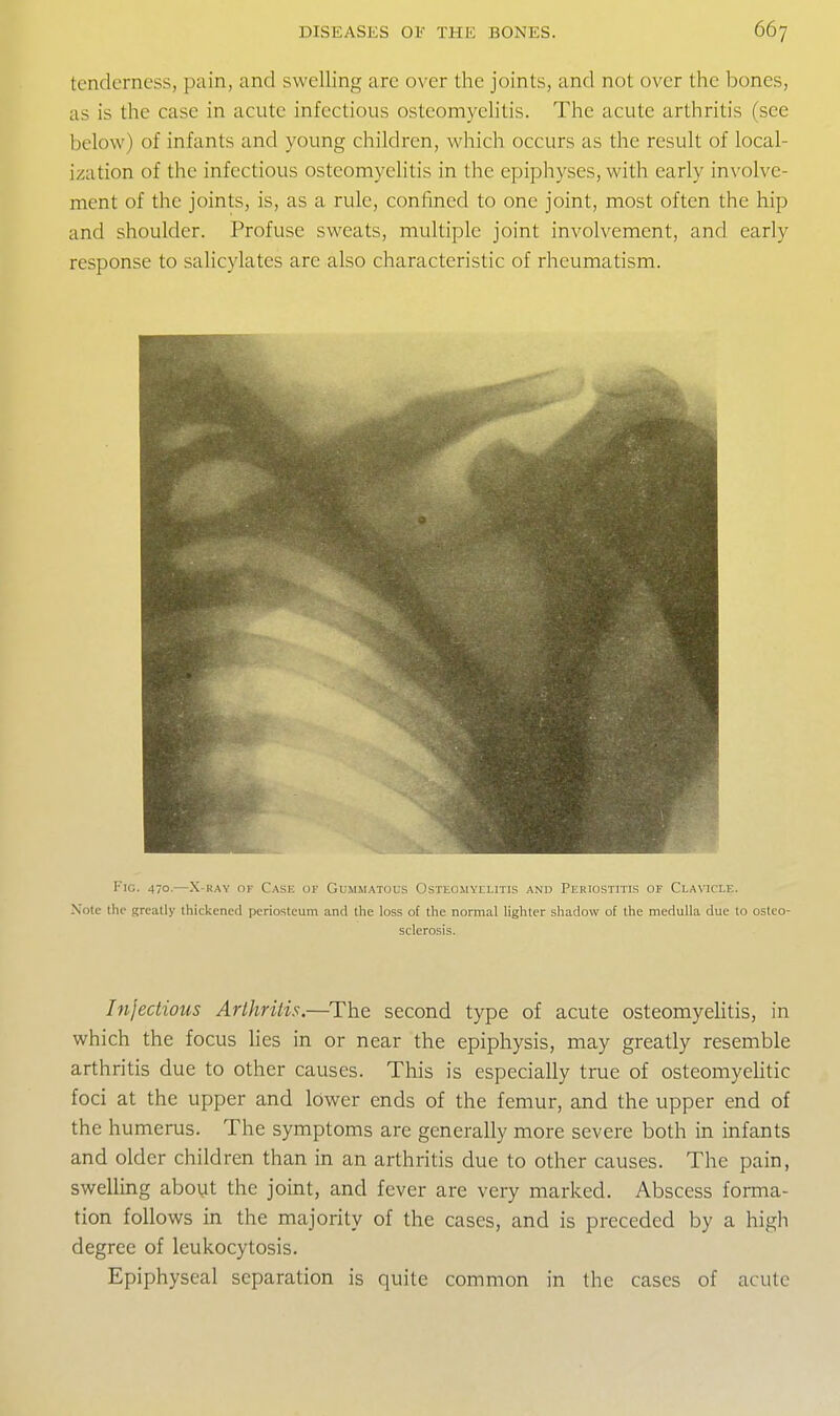 tenderness, pain, and swelling are over the joints, and not over the bones, as is the case in acute infectious osteomyelitis. The acute arthritis (see below) of infants and young children, which occurs as the result of local- ization of the infectious osteomyelitis in the epiphyses, with early involve- ment of the joints, is, as a rule, confined to one joint, most often the hip and shoulder. Profuse sweats, multiple joint involvement, and early response to salicylates are also characteristic of rheumatism. Fig. 470.—X-RAY OF Case of Gummatous Osteomyelitis and Periostitis of Clavicle. N'ote the greatly thickened periosteum and the loss of the normal lighter shadow of the medulla due to osteo- sclerosis. Infectious Arthritis.—The second type of acute osteomyeHtis, in which the focus hes in or near the epiphysis, may greatly resemble arthritis due to other causes. This is especially true of osteomyeUtic foci at the upper and lower ends of the femur, and the upper end of the humerus. The symptoms are generally more severe both in infants and older children than in an arthritis due to other causes. The pain, swelling aboyt the joint, and fever are very marked. Abscess forma- tion follows in the majority of the cases, and is preceded by a high degree of leukocytosis. Epiphyseal separation is quite common in the cases of acute