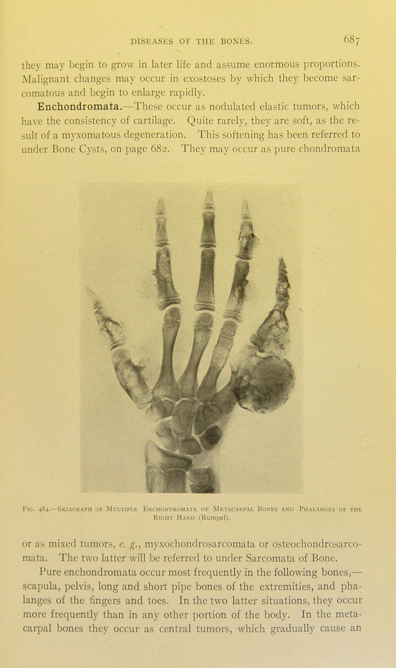 they may begin to grow in later life and assume enormous ijrojjortions. Malignant changes may occur in exostoses by which they become sar- comatous and begin to enlarge rapidly. Enchondromata.—These occur as nodulated elastic tumors, which have the consistency of cartilage. Quite rarely, they are soft, as the re- sult of a myxomatous degeneration. This softening has been referred to under Bone Cysts, on page 682. They may occur as pure chondromata 0 Fig. 484.—Skiagraph of Multiple F.nxhondromata of Metacarpal Bones anmi Phalanges of the Right Hand (Rumpel). • or as mixed tumors, e. g., myxochondrosarcomata or osteochondrosarco- mata. The two latter will be referred to under Sarcomata of Bone. Pure enchondromata occur most frequently in the following bones,— scapula, pelvis, long and short pipe bones of the extremities, and pha- langes of the fingers and toes. In the two latter situations, they occur more frequently than in any other portion of the body. In the meta- carpal bones they occur as central tumors, which gradually cause an