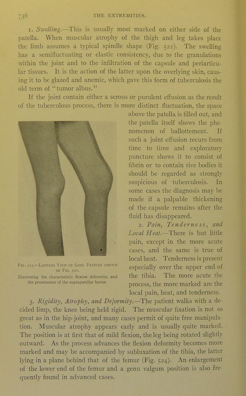 I. Su'eUing.—This is usually most marked on either side of the patella. When muscular atrophy of the thigh and leg takes place the Umb assumes a typical spindle shape (Fig. 522). The swelling has a semifluctuating or elastic consistency, due to the granulations within the joint and to the infiltration of the capsule and periarticu- lar tissues. It is the action of the latter upon the overlying skin, caus- ing it to be glazed and anemic, which gave this form of tuberculosis the old term of tumor albus. If the joint contain either a serous or purulent effusion as the result of the tuberculous process, there is more distinct fluctuation, the space above the patella is filled out, and the patella itself shows the phe- nomenon of ballottement. If such a joint efifusion recurs from time to time and exploratory puncture shows it to consist of fibrin or to contain rice bodies it should be regarded as strongly suspicious of tuberculosis. In some cases the diagnosis may be made if a palpable thickening of the capsule remains after the fluid has disappeared. 2. Pain, Tenderness, and Local Heat.-—There is but little pain, except in the more acute cases, and the same is true of local heat. Tenderness is present especially over the upper end of the tibia. The more acute ihc process, the more marked are the local pain, heat, and tenderness. 3. Rigidity, Atrophy, and Dejormity.—The patient -walks with a de- cided hmp, the knee being held rigid. The muscular fixation is not so great as in the hip-joint, and many cases permit of quite free manipula- tion. Muscular atrophy appears early and is usually quite marked. The position is at first that of mild flexion, the leg being rotated slightly outward. As the process advances the flexion deformity becomes more marked and may be accompanied by subluxation of the tibia, the latter lying in a plane behind that of the femur (Fig. 524). An enlargement of the lower end of the femur and a genu valgum position is also fre- quently found in advanced cases. Fig. 523.—Lateral View of Same Patient shown IN Fig. 522. Illu.strating the characteristic flexion deformity, and the prominence of the suprapatellar burs-t.