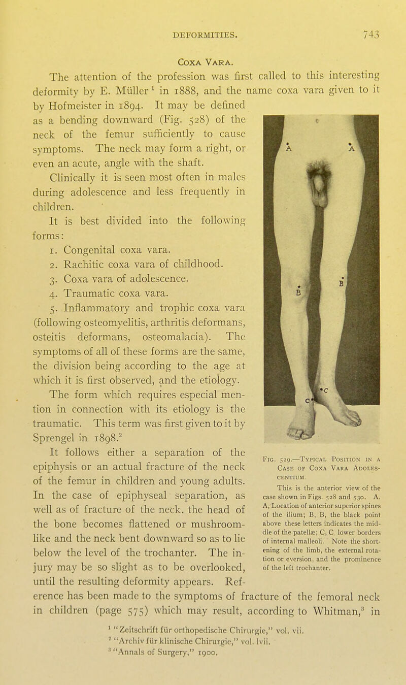 Coxa Vara. The attention of the profession was first called to this interesting deformity by E. Mtiller ^ in 1888, and the name coxa vara given to it by Hofmeister in 1894. It may be defined as a bending downward (Fig. 528) of the neck of the femur sufficiently to cause symptoms. The neck may form a right, or even an acute, angle with the shaft. Chnically it is seen most often in males during adolescence and less frequently in children. It is best divided into the following forms: 1. Congenital coxa vara. 2. Rachitic coxa vara of childhood. 3. Coxa vara of adolescence. 4. Traumatic coxa vara. 5. Inflammatory and trophic coxa vara (following osteomyelitis, arthritis deformans, osteitis deformans, osteomalacia). The symptoms of all of these forms are the same, the division being according to the age at which it is first observed, and the etiology. The form which requires especial men- tion in connection with its etiology is the traumatic. This term was first given to it by Sprengel in 1898.^ It follows either a separation of the epiphysis or an actual fracture of the neck of the femur in children and young adults. In the case of epiphyseal separation, as well as of fracture of the neck, the head of the bone becomes flattened or mushroom- like and the neck bent downward so as to lie below the level of the trochanter. The in- jury may be so slight as to be overlooked, until the resulting deformity appears. Ref- erence has been made to the symptoms of fracture of the femoral neck in children (page 575) which may result, according to Whitman,^ in ' Zeitschrift fiir orthopedische Chinirgie, vol. vii. ' Archiv fiir klinischc Chirurgie, vol. Ivii. Annals of Surgery, 1900. Fig. 52t)-—Typical Position in a Case of Coxa Vara Adoles- CENTIUM. This is the anterior view of llie case shown in Figs. 528 and 530. A, A, Location of anterior superior spines of the ilium; B, B, the black point above these letters indicates the mid- dle of the patell.-c; C, C lower borders of internal malleoli. Note the short- ening of the limb, the external rota- tion or eversion, and the prominence of the left trochanter.