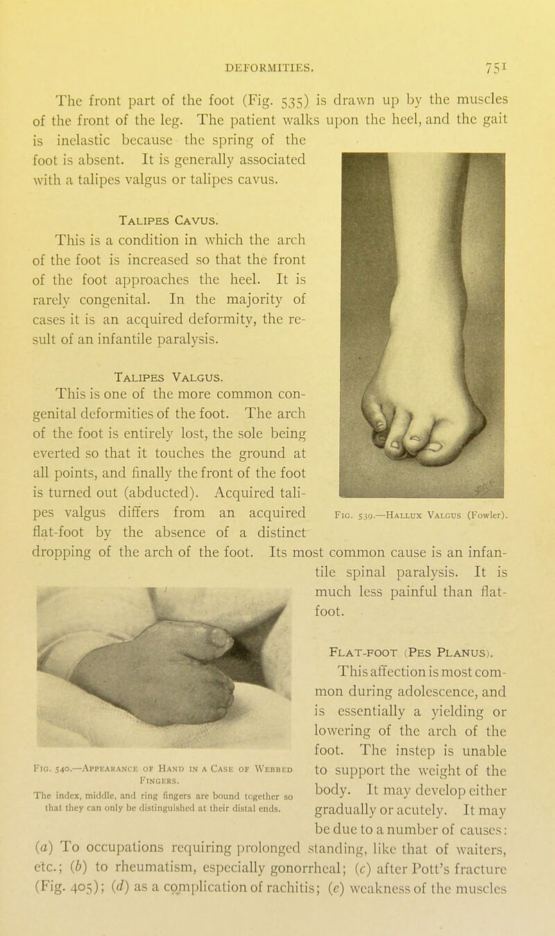 The front part of the foot (Fig. 535) is drawn up by the muscles of the front of the leg. The patient walks upon the heel, and the gait is inelastic because the spring of the foot is absent. It is generally associated with a talipes valgus or talipes cavus. Talipes Cavus. This is a condition in which the arch of the foot is increased so that the front of the foot approaches the heel. It is rarely congenital. In the majority of cases it is an acquired deformity, the re- sult of an infantile paralysis. Talipes Valgus. This is one of the more common con- genital deformities of the foot. The arch of the foot is entirely lost, the sole being everted so that it touches the ground at all points, and finally the front of the foot is turned out (abducted). Acquired tali- pes valgus differs from an acquired flat-foot by the absence of a distinct dropping of the arch of the foot. Its most common cause is an infan- tile spinal paralysis. It is much less painful than flat- foot. Flat-foot (Pes Planus). This affection is most com- mon during adolescence, and is essentially a yielding or lowering of the arch of the foot. The instep is unable to support the weight of the body. It may develop either gradually or acutely. It may be due to a number of causes: (a) To occupations requiring prolonged standing, like that of waiters, etc.; (b) to rheumatism, especially gonorrheal; (c) after Pott's fracture (Fig. 405); (d) as a complication of rachitis; (c) weakness of the muscles Fig. S3g.—Hallux Valgos (Fowler). Fig. 540.—.\PPEARANCE OF Hand in a Case of Wedded Fingers. The index, middle, and ring fingers are bound together so that they can only be distinguished at their distal ends.