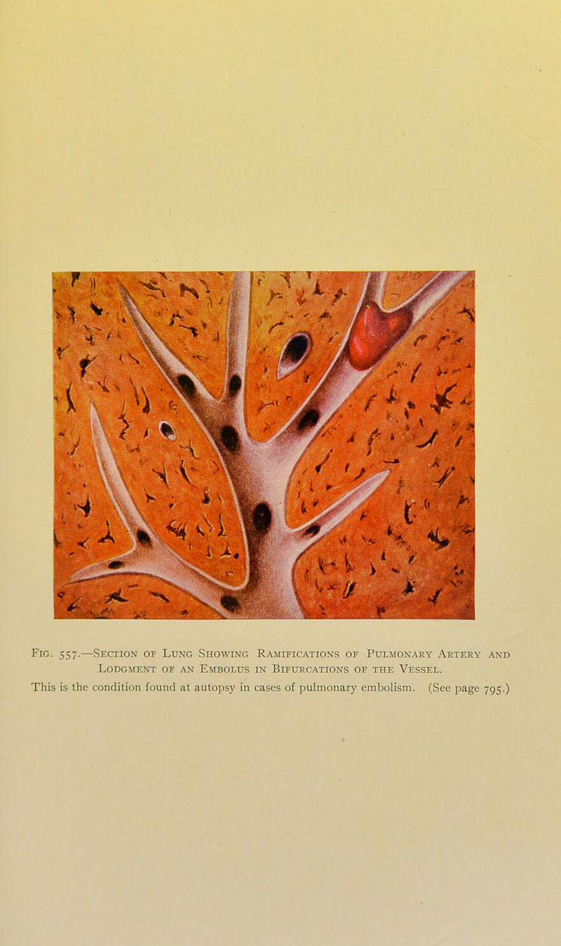 Fig. 557.—Section of Lung Showing Ramifications of Pulmonary Artery and Lodgment of an Embolus in Bifurcations of the Vessel.