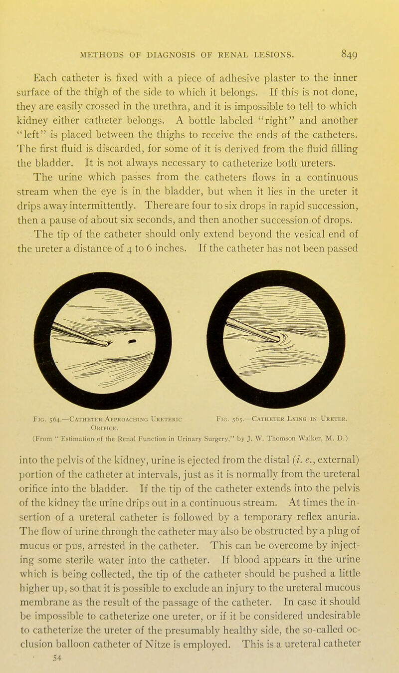 Each catheter is fixed with a piece of adhesive plaster to the inner surface of the thigh of the side to which it belongs. If this is not done, they are easily crossed in the urethra, and it is impossible to tell to which kidney either catheter belongs. A bottle labeled right and another left is placed between the thighs to receive the ends of the catheters. The first fluid is discarded, for some of it is derived from the fluid filling the bladder. It is not always necessary to catheterize both ureters. The urine which passes from the catheters flows in a continuous stream when the eye is in the bladder, but when it lies in the ureter it drips away intermittently. There are four to six drops in rapid succession, then a pause of about six seconds, and then another succession of drops. The tip of the catheter should only extend beyond the vesical end of the ureter a distance of 4 to 6 inches. If the catheter has not been passed Fig. 564.—Catheter Afproaching Ureteric Fig. 565.—Cwheter Lying in Ureter. Orifice. (From  Estimation of the Renal Function in Urinary Surgery, by J. W. Thomson Walker, M. D.) into the pelvis of the kidney, urine is ejected from the distal (i. e., external) portion of the catheter at intervals, just as it is normally from the ureteral orifice into the bladder. If the tip of the catheter extends into the pelvis of the kidney the urine drips out in a continuous stream. At times the in- sertion of a ureteral catheter is followed by a temporary reflex anuria. The flow of urine through the catheter may also be obstructed by a plug of mucus or pus, arrested in the catheter. This can be overcome by inject- ing some sterile water into the catheter. If blood appears in the urine which is being collected, the tip of the catheter should be pushed a little higher up, so that it is possible to exclude an injury to the ureteral mucous membrane as the result of the passage of the catheter. In case it should be impossible to catheterize one ureter, or if it be considered undesirable to catheterize the ureter of the presumably healthy side, the so-called oc- clusion balloon catheter of Nitze is employed. This is a ureteral catheter 54