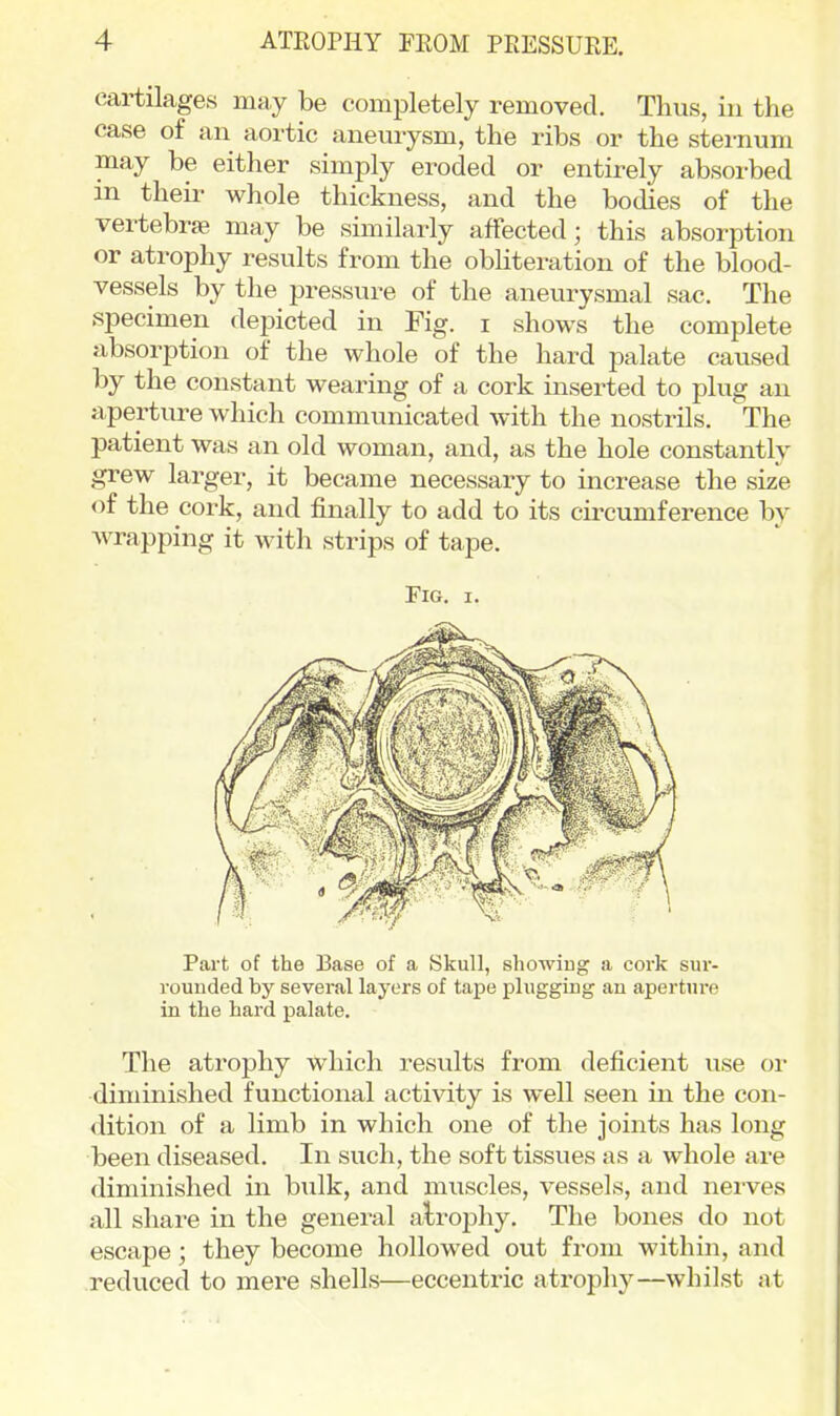 cartilages may be completely removed. Thus, in the case of an aortic aneurysm, the ribs or the sternum may be either simply eroded or entirely absorbed in theii- whole thickness, and the bodies of the vertebrae may be similarly affected; this absorption or atrophy results from the obliteration of the blood- vessels by the pressure of the aneurysmal sac. The specimen depicted in Fig. i shows the complete absorption of the whole of the hard palate caused by the constant wearing of a cork inserted to plug an aperture which communicated with the nostrils. The patient was an old woman, and, as the hole constantly grew larger, it became necessary to increase the size of the cork, and finally to add to its circumference by wrapping it with strips of tape. Fig. I. Part of the Base of a Skull, showing a cork sur- rounded by several layers of tape plugging an aperture in the hard palate. The atrophy which results from deficient use or diminished functional activity is well seen in the con- dition of a limb in which one of the joints has long been diseased. In such, the soft tissues as a whole are diminished in bxilk, and muscles, vessels, and nerves all share in the general atroj^hy. The bones do not escape; they become hollowed out from within, and reduced to mere shells—eccentric atrophy—whilst at