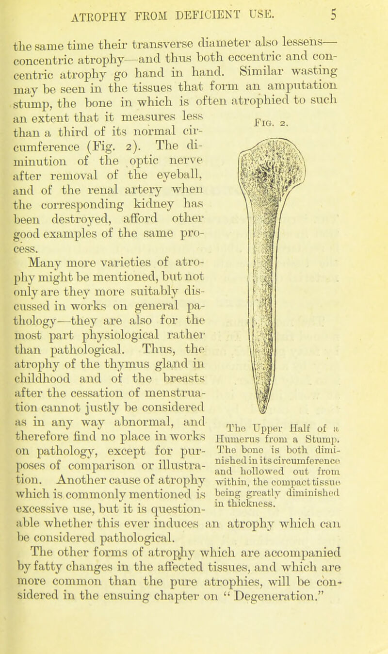 Fig. 2. the same time their transverse diameter also lessens— concentric atrophy—and thus both eccentric and con- centric atrophy go hand in hand. Similar wasting may be seen in the tissues that form an amputation stump, the bone in which is often atrophied to such an extent that it measures less than a third of its normal cii'- cumference (Fig. 2). The di- minution of the optic nerve after removal of the eyeball, and of the renal artery when the corresponding kidney has been destroyed, afford other good examples of the same pro- cess. Many more varieties of atro- phy might be mentioned, but not only are they more suitably dis- cussed in works on general pa- thology—they are also for the most part physiological rathei' than pathological. Thus, the atrophy of the thymus gland in childhood and of the breasts after the cessation of menstrua- tion cannot justly be considered as in any way abnormal, and therefore find no place in works on pathology, except for pur- poses of comparison or illustra- tion. Another cause of atrophy which is commonly mentioned is being greatly dimimshed excessive use, but it is question- tl^ickness. able whether this ever induces an atrophy which can be considered pathological. The other forms of atropliy which are accompanied by fatty changes in the affected tissues, and which are more common than the pure atrophies, will be con- sidered in the ensuing chapter on  Degeneration. The Upper Half of a Humerus from a Stump. The bone is both dimi- nished in its circumferenco and hollowed out from within, the compact tissu(*