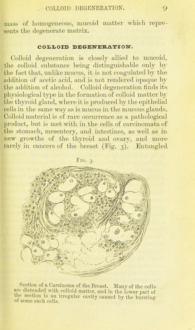mass of homogeneous, mucoid matter which repre- sents the degenerate matrix* COI.I.OID BEGEITERiiTZOir. Colloid degeneration is closely allied to mucoid^ the colloid substance being distinguishable only by the fact that, unlike mucus, it is not coagulated by the addition of acetic acid, and is not rendered opaque by the addition of alcohol. Colloid degeneration finds its physiological type in the formation of colloid matter by the thp'oid gland, where it is produced by the epithelial cells in the same way as is mucus in the mucous glands^ Colloid material is of rare occurrence as a pathological product, but is met with in the cells of carcinomata of the stomach, mesentery, and intestines, as well as in new gi'owths of the thyroid and ovary, and more- rai-ely in cancers of the breast (Fig. 3). Entangled Fig. 3. Section of a Carcinoma of the.Breast. Many of the cells- are distended with colloid matter, and in the lower part of the section is an in-egiilar cavitv caused by the bnrstiuff of some such cells. '