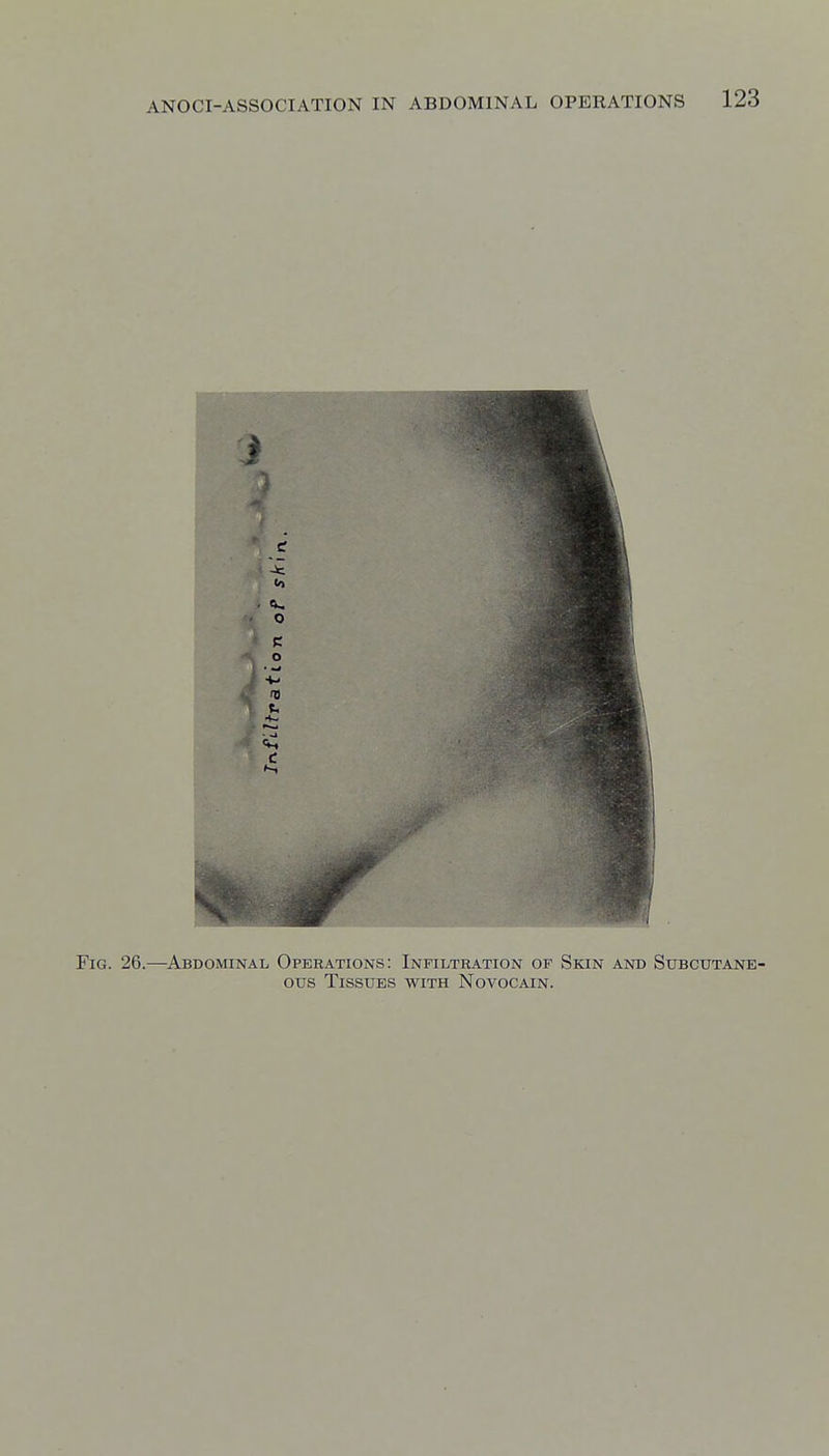 Fig. 26.—^Abdominal Operations: Infiltration of Skin and Subcutane- ous Tissues with Novocain.